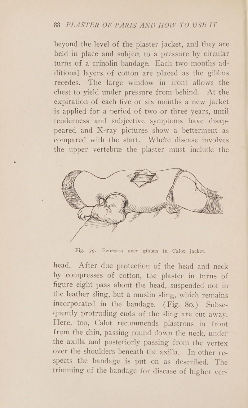 beyond the level of the plaster jacket, and they are held in place and subject to a pressure by circular turns of a crinolin bandage. Each two months ad- ditional layers of cotton are placed as the gibbus recedes. The large window in front allows the chest to yield under pressure from behind. At the expiration of each five or six months a new jacket is applied for a period of two or three years, until tenderness and subjective symptoms have disap- peared and X-ray pictures show a betterment as compared with the start. Where disease involves the upper vertebrze the plaster must include the head. After due protection of the head and neck by compresses of cotton, the plaster in turns of figure eight pass about the head, suspended not in the leather sling, but a muslin sling, which remains incorporated in the bandage. (Fig. 80.) Subse- quently protruding ends of the sling are cut away. Here, too, Calot recommends plastrons in front from the chin, passing round down the neck, under the axilla and posteriorly passing from the vertex over the shoulders beneath the axilla. In other re- spects the bandage is put on as described. The trimming of the bandage for disease of higher ver-