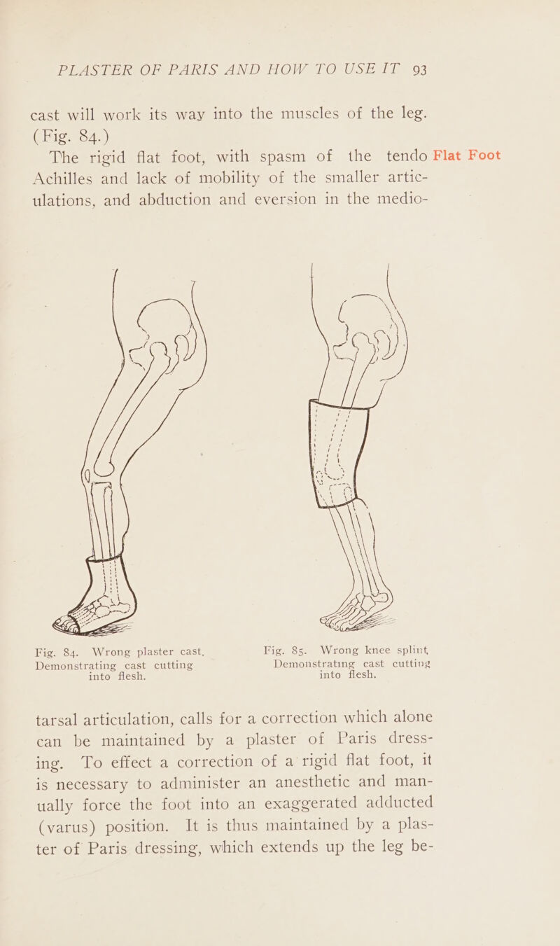 cast will work its way into the muscles of the leg. (Fig. 84.) The rigid flat foot, with spasm of the tendo Flat Foot Achilles and lack of mobility of the smaller artic- ulations, and abduction and eversion in the medio- Fig. 84. Wrong plaster cast. Fig. 8s. Wrong knee splint, Demonstrating cast cutting Demonstrating cast cutting into flesh. into flesh. tarsal articulation, calls for a correction which alone can be maintained by a plaster of Paris dress- ing. To effect a correction of a rigid flat foot, it is necessary to administer an anesthetic and man- ually force the foot into an exaggerated adducted (varus) position. It is thus maintained by a plas- ter of Paris dressing, which extends up the leg be-