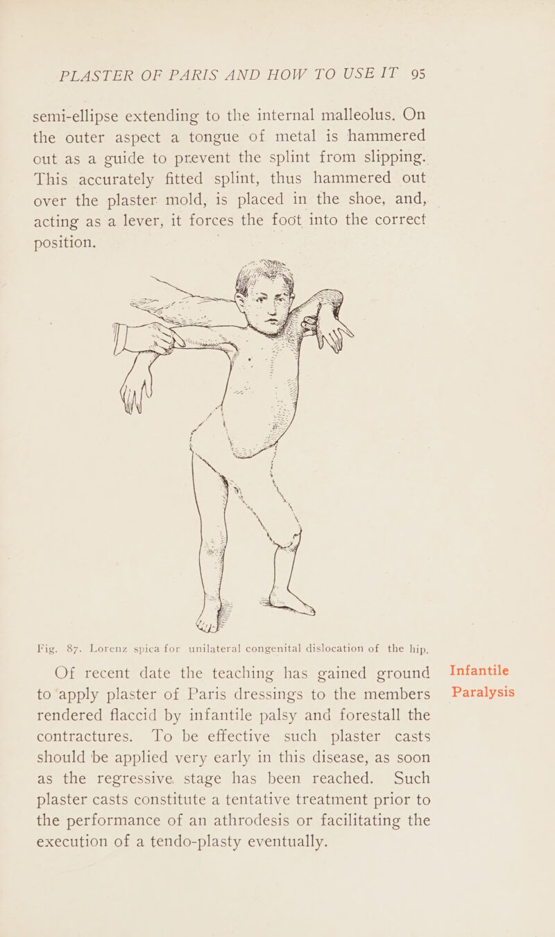 semi-ellipse extending to the internal malleolus. On the outer aspect a tongue of metal is hammered out as a guide to prevent the splint from slipping. This accurately fitted splint, thus hammered out over the plaster mold, is placed in the shoe, and, acting as a lever, it forces the foot into the correct position. Fig. 87. Lorenz spica for unilateral congenital dislocation of the hip, Of recent date the teaching has gained ground to apply plaster of Paris dressings to the members rendered flaccid by infantile palsy and forestall the eomtracttres, No be effective. such @plaster™ casts should ‘be applied very early in this disease, as soon as the regressive stage has been reached. Such plaster casts constitute a tentative treatment prior to the performance of an athrodesis or facilitating the execution of a tendo-plasty eventually. Infantile Paralysis