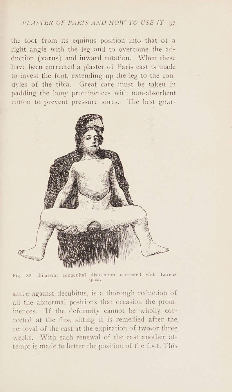 the foot from its equinus position into that of a right angle with the leg and to overcome the ad- duction (varus) and inward rotation, When these have ‘been corrected a plaster of Paris cast is made to invest the foot, extending up the leg. to the con- dyles of the tibia. Great care must be taken in padding the bony prominences with non-absorbent cotton to prevent pressure sores. The best guar- Fig. 88. Bilateral congenital dislocation corrected with Lorenz spica. antee against decubitus, is a thorough reduction of all the abnormal positions that occasion the prom- inences. If the deformity cannot be wholly cor- rected at the first sitting it is remedied after the removal of the cast at the expiration of two.or three weeks. With each renewal of the cast another at- tempt is made to better the position of the foot. This