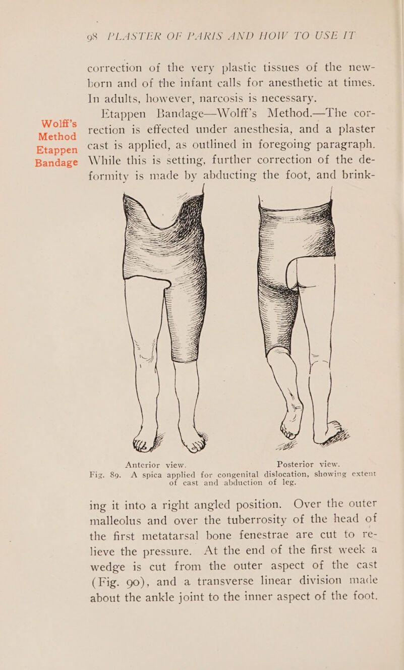 Wolff’s Method Etappen Bandage 68 “PLASTER OF PARIS Wer OW LOTUS fis correction of the very plastic tissues of the new- born and of the infant calls for anesthetic at times. In adults, however, narcosis is necessary. Etappen Bandage—Wolff’s Method.—The cor- rection is effected under anesthesia, and a plaster cast is applied, as outlined in foregoing paragraph. While this is setting, further correction of the de- formity is made by abducting the foot, and brink- ing it into a right angled position. Over the outer malleolus and over the tuberrosity of the head of the first metatarsal bone fenestrae are cut to re- lieve the pressure. At the end of the first week a wedge is cut from the outer aspect of the cast (Fig. 90), and a transverse linear division made about the ankle joint to the inner aspect of the foot.