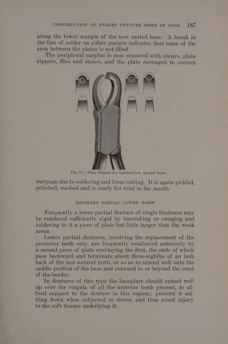 along the lower margin of the now united base. A break in the line of solder on either margin indicates that some of the area between the plates is not filled. The peripheral surplus is now removed with shears, plate nippers, files and stones, and the plate reswaged to correct WAMU: BAN \\\\ Fig. 79.— Plate Nippers for Cutting Plate Around Teeth warpage due to soldering and from cutt Ang. It is again pickled, polished, washed and is ready for trial in the mouth. DOUBLING PARTIAL LOWER BASES Frequently a lower partial denture of single thickness may be rendered sufficiently rigid by burnishing or swaging and soldering to it a piece of plate but little larger than the weak areas. Lower partial dentures, involving the replacement of the posterior teeth only, are frogiientle reinforced anteriorly by a second piece of plate overlaying the first, the ends of which pass backward and terminate about three-eighths of an inch back of the last natural teeth, or so as to extend well onto the saddle portion of the base and outward to or beyond the crest of the border. In dentures of this type the baseplate aol extend well up over the cingula of all the anterior teeth present, to af- ford support to the denture in this region; prevent it set- tling down when subjected to stress, and thus avoid injury to the soft tissues underlying it.