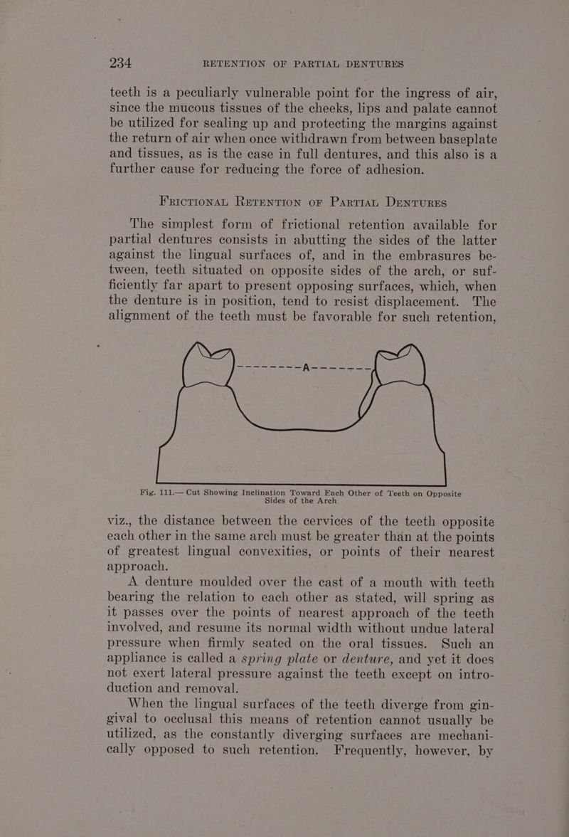 teeth is a peculiarly vulnerable point for the ingress of air, since the mucous tissues of the cheeks, lips and palate cannot be utilized for sealing up and protecting the margins against the return of air when once withdrawn from between baseplate and tissues, as is the case in full dentures, and this also is a further cause for reducing the force of adhesion. ~ Friotionat Rerention oF ParriraL DENTURES The simplest form of frictional retention available for partial dentures consists in abutting the sides of the latter against the lingual surfaces of, and in the embrasures be- tween, teeth situated on opposite sides of the arch, or suf- ficiently far apart to present opposing surfaces, which, when the denture is in position, tend to resist displacement. The alignment of the teeth must be favorable for such retention, Fig. 111.— Cut Showing mea ave Pee apexes, Other of Teeth on Opposite viz., the distance between the cervices of the teeth opposite each other in the same arch must be greater than at the points of greatest lingual convexities, or points of their nearest approach. A denture moulded over the cast of a mouth with teeth bearing the relation to each other as stated, will spring as it passes over the points of nearest approach of the teeth involved, and resume its normal width without undue lateral pressure when firmly seated on the oral tissues. Such an appliance is called a spring plate or denture, and yet it does not exert lateral pressure against the teeth except on intro- duction and removal. When the lingual surfaces of the teeth diverge from gin- gival to occlusal this means of retention cannot usually be utilized, as the constantly diverging surfaces are mechani- cally opposed to such retention. Frequently, however, by