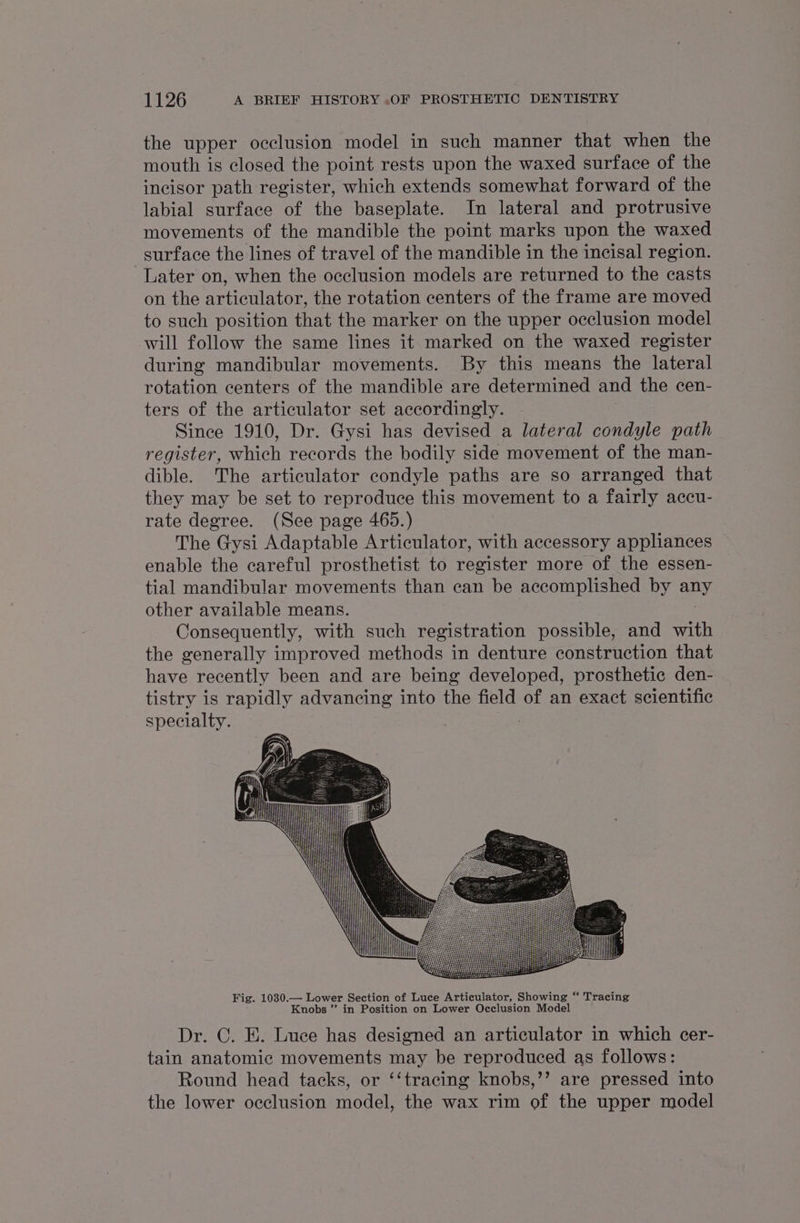 the upper occlusion model in such manner that when the mouth is closed the point rests upon the waxed surface of the incisor path register, which extends somewhat forward of the labial surface of the baseplate. In lateral and protrusive movements of the mandible the point marks upon the waxed surface the lines of travel of the mandible in the incisal region. Later on, when the occlusion models are returned to the casts on the articulator, the rotation centers of the frame are moved to such position that the marker on the upper occlusion model will follow the same lines it marked on the waxed register during mandibular movements. By this means the lateral rotation centers of the mandible are determined and the cen- ters of the articulator set accordingly. Since 1910, Dr. Gysi has devised a lateral condyle path register, which records the bodily side movement of the man- dible. The articulator condyle paths are so arranged that they may be set to reproduce this movement to a fairly accu- rate degree. (See page 465.) The Gysi Adaptable Articulator, with accessory appliances enable the careful prosthetist to register more of the essen- tial mandibular movements than can be accomplished by any other available means. Consequently, with such registration possible, and with the generally improved methods in denture construction that have recently been and are being developed, prosthetic den- tistry is rapidly advancing into the field of an exact scientific specialty. | Fig. 1030.— Lower Section of Luce Articulator, Showing “ Tracing Knobs ” in Position on Lower Occlusion Model Dr. C. E. Luce has designed an articulator in which cer- tain anatomic movements may be reproduced as follows: Round head tacks, or ‘‘tracing knobs,’’ are pressed into the lower occlusion model, the wax rim of the upper model
