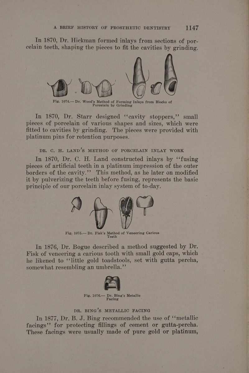 In 1870, Dr. Hickman formed inlays from sections of por- celain teeth, shaping the pieces to fit the cavities by grinding. In 1870, Dr. Starr designed ‘‘cavity stoppers,’’ small pieces of porcelain of various shapes and sizes, which were fitted to cavities by grinding. The pieces were provided with platinum pins for retention purposes. DR. C. H. LAND’S METHOD OF PORCELAIN INLAY WORK In 1870, Dr. C. H. Land constructed inlays by ‘‘fusing pieces of artificial teeth in a platinum impression of the outer borders of the cavity.’’ This method, as he later on modified it by pulverizing the teeth before fusing, represents the basic principle of our porcelain inlay system of to-day. Fig. 1075.— Dr. Fisk’s Method e SAVES Carious In 1876, Dr. Bogue described a method suggested by Dr. Fisk of veneering a carious tooth with small gold caps, which he likened to ‘‘little gold toadstools, set with gutta percha, somewhat resembling an umbrella.’’ DR. BING’S METALLIC FACING In 1877, Dr. B. J. Bing recommended the use of ‘‘metallic facings’’ for protecting fillings of cement or gutta-percha. These facings were usually made of pure gold or platinum,