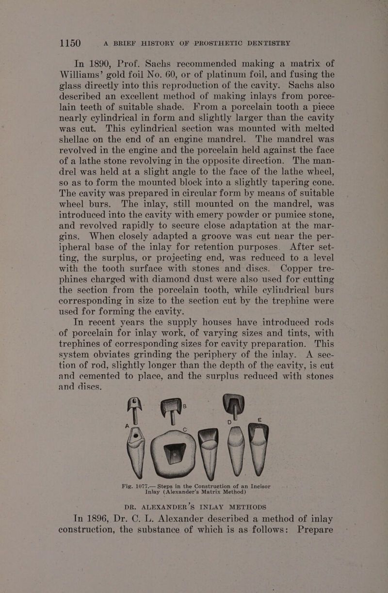 In 1890, Prof. Sachs recommended making a matrix of Williams’ gold foil No. 60, or of platinum foil, and fusing the glass directly into this reproduction of the cavity. Sachs also described an excellent method of making inlays from porce- lain teeth of suitable shade. From a porcelain tooth a piece nearly cylindrical in form and slightly larger than the cavity was cut. This cylindrical section was mounted with melted shellac on the end of an engine mandrel. The mandrel was revolved in the engine and the porcelain held against the face of a lathe stone revolving in the opposite direction. The man- drel was held at a slight angle to the face of the lathe wheel, so as to form the mounted block into a shghtly tapering cone. The cavity was prepared in circular form by means of suitable wheel burs. The inlay, still mounted on the mandrel, was introduced into the cavity with emery powder or pumice stone, and revolved rapidly to secure close adaptation at the mar- gins. When closely adapted a groove was cut near the per- ipheral base of the inlay for retention purposes. After set- ting, the surplus, or projecting end, was reduced to a level with the tooth surface with stones and discs. Copper tre- phines charged with diamond dust were also used for cutting the section from the porcelain tooth, while cylindrical burs corresponding in size to the section cut by the trephine were used for forming the cavity. In recent years the supply houses have introduced rods of porcelain for inlay work, of varying sizes and tints, with trephines of corresponding sizes for cavity preparation. This - system obviates grinding the periphery of the inlay. A sec- tion of rod, slightly longer than the depth of the cavity, is cut and cemented to place, and the surplus reduced with stones and dises. Fig. 1077.— Steps in the Construction of an Incisor Inlay (Alexander’s Matrix Metho DR. ALEXANDER’S INLAY METHODS In 1896, Dr. C. L. Alexander described a method of inlay construction, the substance of which is as follows: Prepare