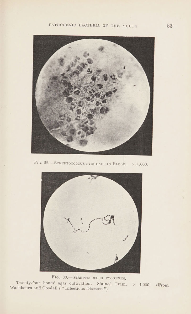 Fig. 32.--StrREPTococcus PYOGENES IN BLoop. x 1,000. x 1,000, 83 (From