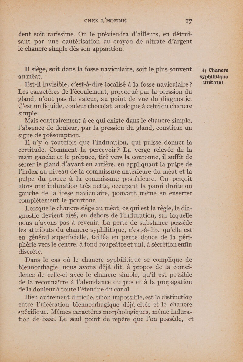 dent soit rarissime. On le préviendra d’ailleurs, en détrui- sant par une cautérisation au crayon de nitrate d'argent le chancre simple dès son appärition. au méat. . Est-il invisible, c’est-à-dire localisé à la fosse naviculaire ? Les caractères de l'écoulement, provoqué par la pression du gland, n’ont pas de valeur, au point de vue du diagnostic. C’est un liquide, couleur chocolat, analogue à celui du chancre simple. Mais contrairement à ce qui existe dans le chancre simple, l’absence de douleur, par la pression du gland, constitue un signe de présomption. _ I n’y a toutefois que l’induration, qui puisse donner Îa certitude. Comment la percevoir? La verge relevée de la main gauche et le prépuce, tiré vers la couronne, il suffit de serrer le gland d’avant en arrière, en appliquant la pulpe de l'index au niveau de la commissure antérieure du méat et la pulpe du pouce à la commissure postérieure. On perçoit alors une induration très nette, occupant la paroi droite ou gauche de la fosse naviculaire, pouvant même en enserrer complètement le pourtour. Lorsque le chancre siège au méat, ce qui est la règle, le dia- gnostic devient aisé, en dehors de l’induration, sur laquelle nous n’avons pas à revenir. La perte de substance possède les attributs du chancre syphilitique, c’est-à-dire qu’elle est en général superficielle, taillée en pente douce de la péri- phérie vers le centre, à fond rougeâtre et uni, à sécrétion enfin discrète. Dans le cas où le chancre syphilitique se complique de blennorrhagie, nous avons déjà dit, à propos de la coïnci- dence de celle-ci avec le chancre simple, qu’il est possible de la reconnaître à l’abondance du pus et à la propagation de la douleur à toute l’étendue du canal. Bien autrement difficile, sinon impossible, est la distinction entre l’ulcération blennorrhagique déjà citée et le chancre spécifique. Mêmes caractères morphologiques, même indura- tion de base. Le seul point de repère que l’on possède, et syphilitique due j'a ue