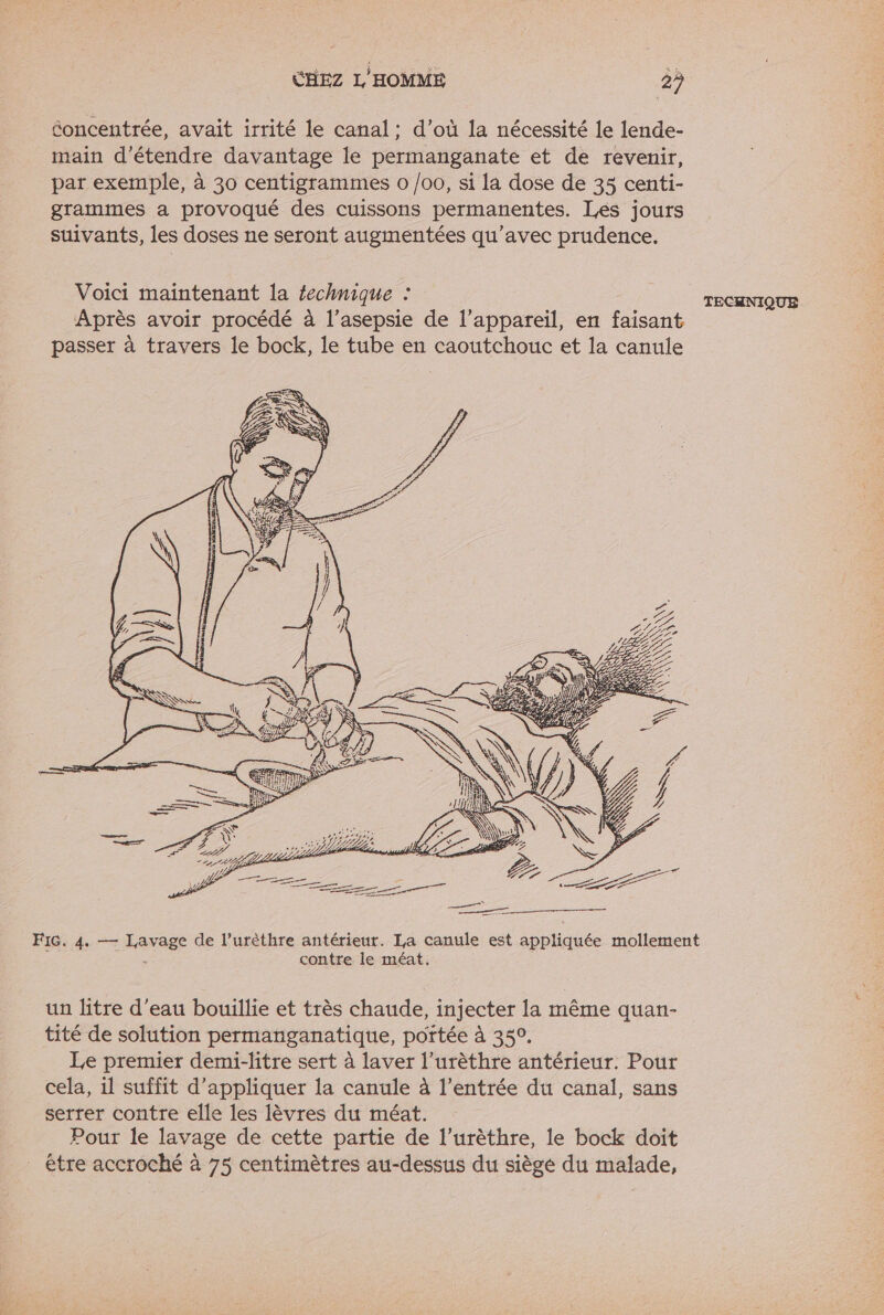 concentrée, avait irrité le canal : d’où la nécessité le lende- main d'étendre davantage le permanganate et de revenir, par exemple, à 30 centigrammes 0 /00, si la dose de 35 centi- grammes a provoqué des cuissons permanentes. Les jours suivants, les doses ne seront augmentées qu'avec prudence, Voici maintenant la fechnique : TECHNIQUE Après avoir procédé à l’asepsie de l'appareil, en us passer à travers le bock, le tube en caoutchouc et la canule FIG, 4..— AHTaEE de l’urèthre antérieur. Ia canule est appliquée mollement contre le méat. un litre d’eau bouillie et très chaude, injecter la même quan- tité de solution permanganatique, poftée à 35°. Le premier demi-litre sert à laver l’urèthre antérieur. Pour cela, 1l suffit d'appliquer la canule à l’entrée du canal, sans serrer contre elle les lèvres du méat. Pour le lavage de cette partie de l’urèthre, le bock doit être accroché à 75 centimètres au-dessus du siège du malade,