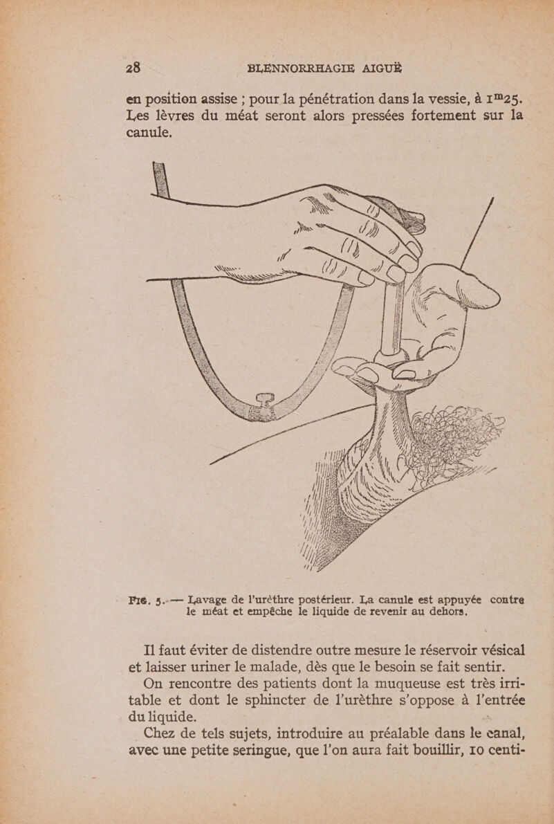 PARTY JM af? AIMER EE: en position assise ; pour la pénétration dans la vessie, à 125. Les lèvres du méat seront alors pressées fortement sur la canule, ! Ke - à SE F1e. 5..— Lavage de l’urèthre postérieur. La canule est appuyée contre le méat et empêche le liquide de revenir au dehors. et laisser uriner le malade, dès que le besoin se fait sentir. On rencontre des patients dont la muqueuse est très irri- table et dont le sphincter de l’urèthre s'oppose à l'entrée du liquide. . _ Chez de tels sujets, introduire au préalable dans le canal, avec une petite seringue, que l’on aura fait bouillir, 10 centi-