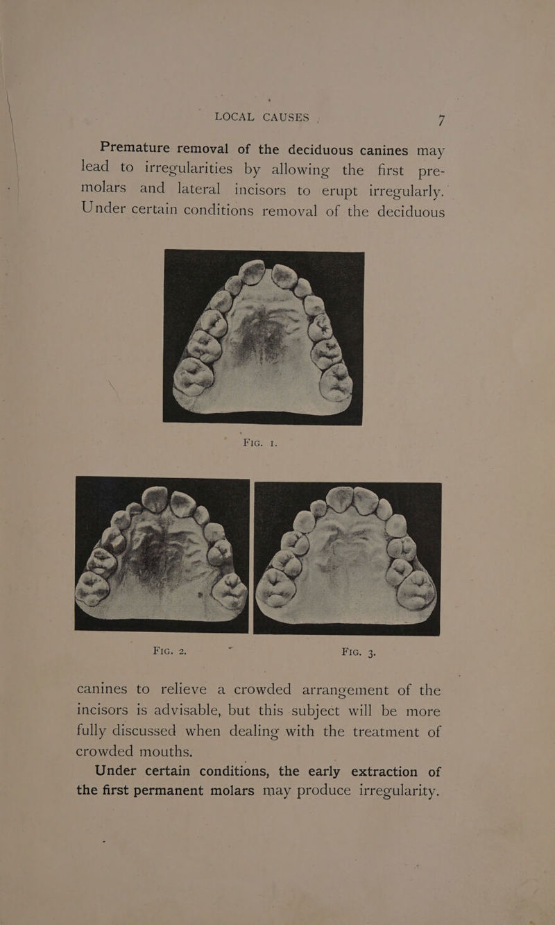 | LOCAL CAUSES fi | Premature removal of the deciduous canines may | lead to irregularities by allowing the first pre- | molars and lateral incisors to erupt irregularly. Under certain conditions removal of the deciduous ine, Te EIGIe3; canines to relieve a crowded arrangement of the incisors is advisable, but this subject will be more fully discussed when dealing with the treatment of crowded mouths. Under certain conditions, the early extraction of the first permanent molars may produce irregularity.
