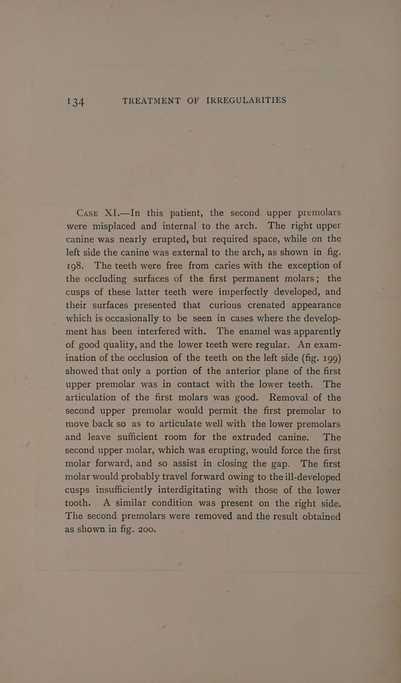 Case XI.—In this patient, the second upper premolars were misplaced and internal to the arch. The right upper canine was nearly erupted, but required space, while on the left side the canine was external to the arch, as shown in fig. 198. The teeth were free from caries with the exception of the occluding surfaces of the first permanent molars; the cusps of these latter teeth were imperfectly developed, and their surfaces presented that curious crenated appearance which is occasionally to be seen in cases where the develop- ment has been interfered with. The enamel was apparently of good quality, and the lower teeth were regular. An exam- ination of the occlusion of the teeth on the left side (fig. 199) showed that only a portion of the anterior plane of the first upper premolar was in contact with the lower teeth. The articulation of the first molars was good. Removal of the second upper premolar would permit the first premolar to move back so as to articulate well with the lower premolars and leave sufficient room for the extruded canine. The second upper molar, which was erupting, would force the first molar forward, and so assist in closing the gap. The first molar would probably travel forward owing to the ill-developed cusps insufficiently interdigitating with those of the lower tooth. A similar condition was present on the right side. The second premolars were removed and the result obtained as shown in fig. 200.
