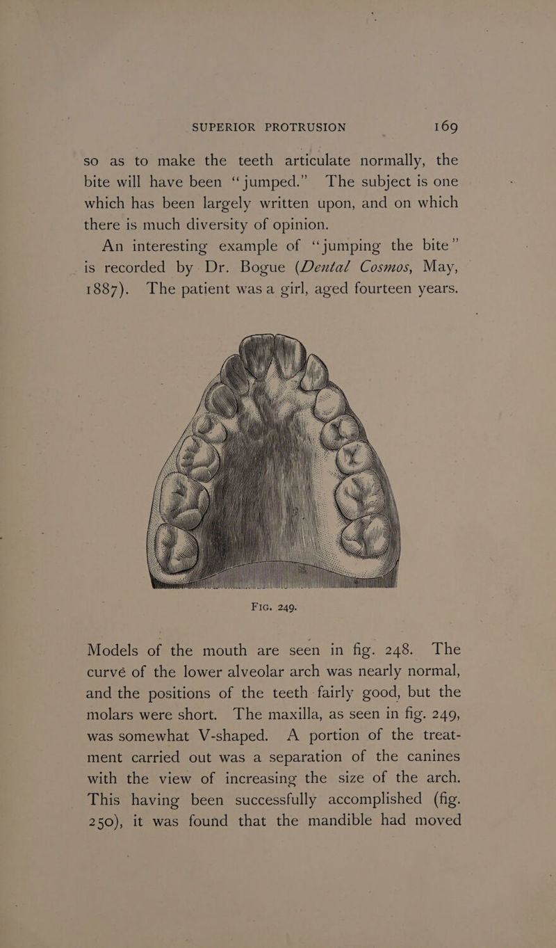 so as to make the teeth articulate normally, the bite will have been “jumped.” The subject is one which has been largely written upon, and on which there is much diversity of opinion. An interesting example of “jumping the bite” is recorded by Dr. Bogue (Dental Cosmos, May, 1887). The patient wasa girl, aged fourteen years. wi i Beame LM Gf \\..: hie T ' / y . \ YY Hy 1] | | Mi WY HY) Models of the mouth are seen in fig. 248. The curvé of the lower alveolar arch was nearly normal, and the positions of the teeth fairly good, but the molars were short. The maxilla, as seen in fig. 249, was somewhat V-shaped. A portion of the treat- ment carried out was a separation of the canines with the view of increasing the size of the arch. This having been successfully accomplished (fig. 250), it was found that the mandible had moved