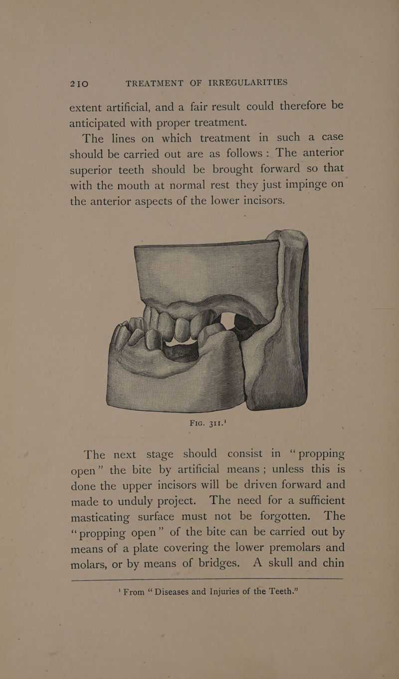 extent artificial, and a fair result could therefore be anticipated with proper treatment. The lines on which treatment in such a case should be carried out are as follows : The anterior superior teeth should be brought forward so that with the mouth at normal rest they just impinge on the anterior aspects of the lower incisors. | The next stage should consist in “ propping open” the bite by artificial means; unless this is done the upper incisors will be driven forward and made to unduly project. The need for a sufficient masticating surface must not be forgotten. The “ propping open” of the bite can be carried out by means of a plate covering the lower premolars and molars, or by means of bridges. A skull and chin ‘From “ Diseases and Injuries of the Teeth.”