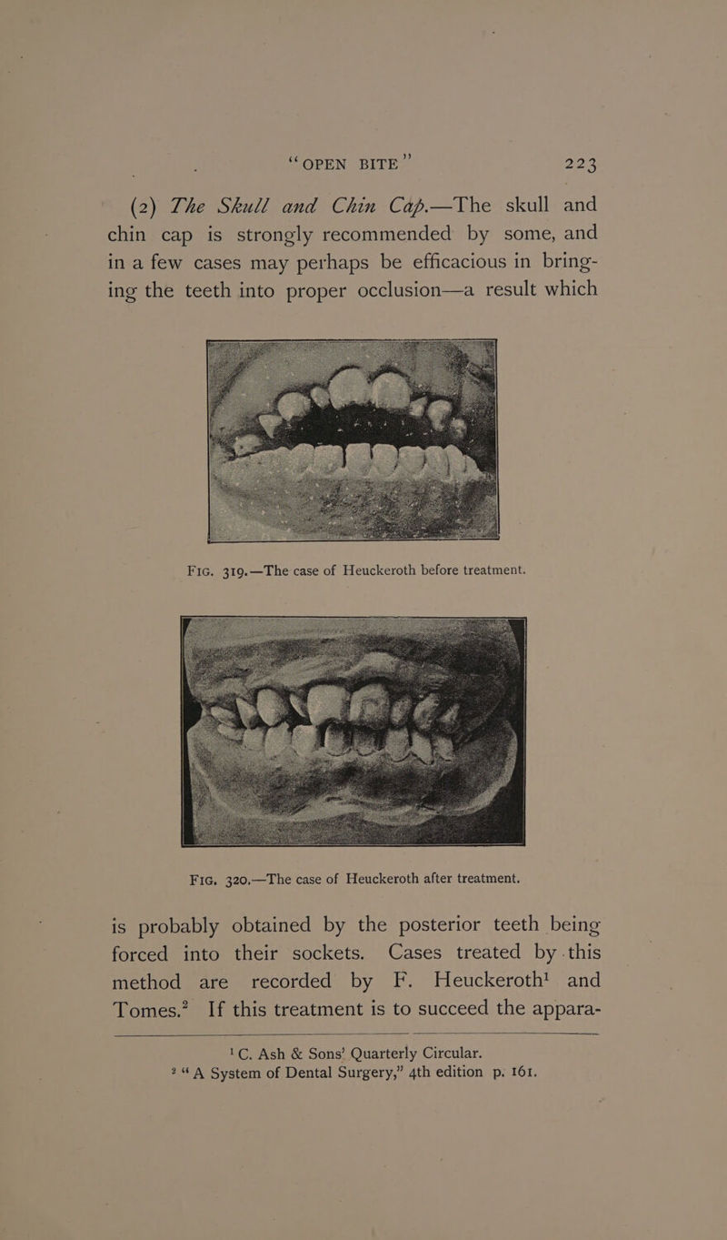 (2) The Skull and Chin Cap.—The skull and chin cap is strongly recommended by some, and in a few cases may perhaps be efficacious in bring- ing the teeth into proper occlusion—a result which Fic. 319.—The case of Heuckeroth before treatment. is probably obtained by the posterior teeth being forced into their sockets. Cases treated by -this method are recorded by F. Heuckeroth! and Tomes.” If this treatment is to succeed the appara- 1C, Ash &amp; Sons’ Quarterly Circular. 2“ A System of Dental Surgery,” 4th edition p. 161.