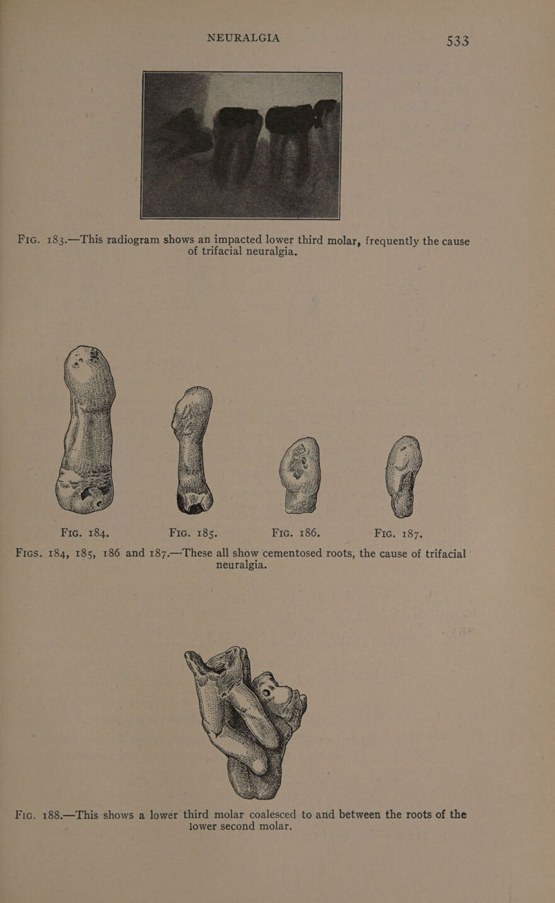 Fic. 183.—This radiogram shows an impacted lower third molar, frequently the cause of trifacial neuralgia. Fic. 184. Fic. 185. Fic. 186. Fic. 187. Fics. 184, 185, 186 and 187.—-These all show cementosed roots, the cause of trifacial : neuralgia. Fic. 188—This shows a lower third molar coalesced to and between the roots of the lower second molar.