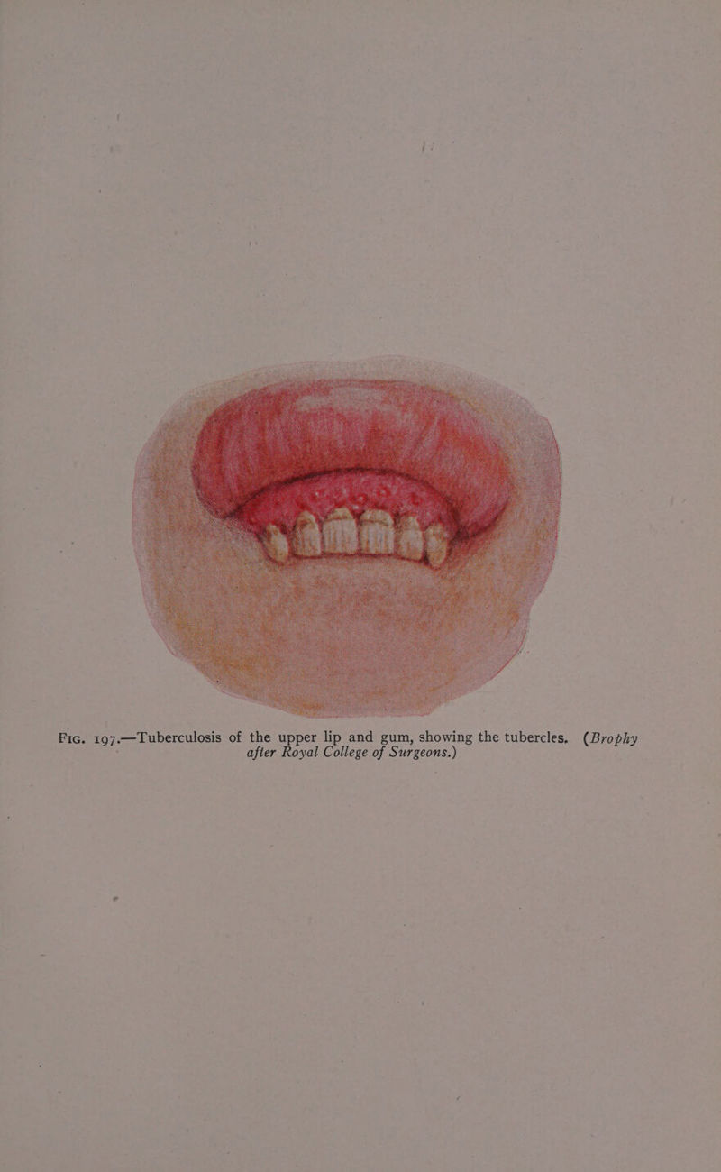 . Fic. 197.—Tuberculosis of the upper lip and gum, showing the tubercles, after Royal College of Surgeons.) (Brophy