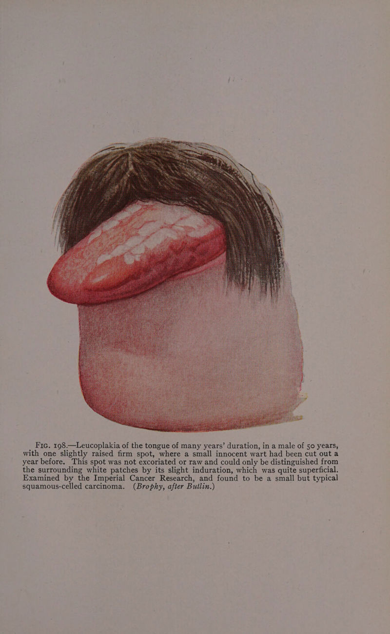 with one slightly raised firm spot, where a small innocent wart had been cut out a year before. This spot was not excoriated or raw and could only be distinguished from the surrounding white patches by its slight induration, which was quite superficial. Examined by the Imperial Cancer Research, and found to be a small but typical squamous-celled carcinoma. (Brophy, after Builin.)