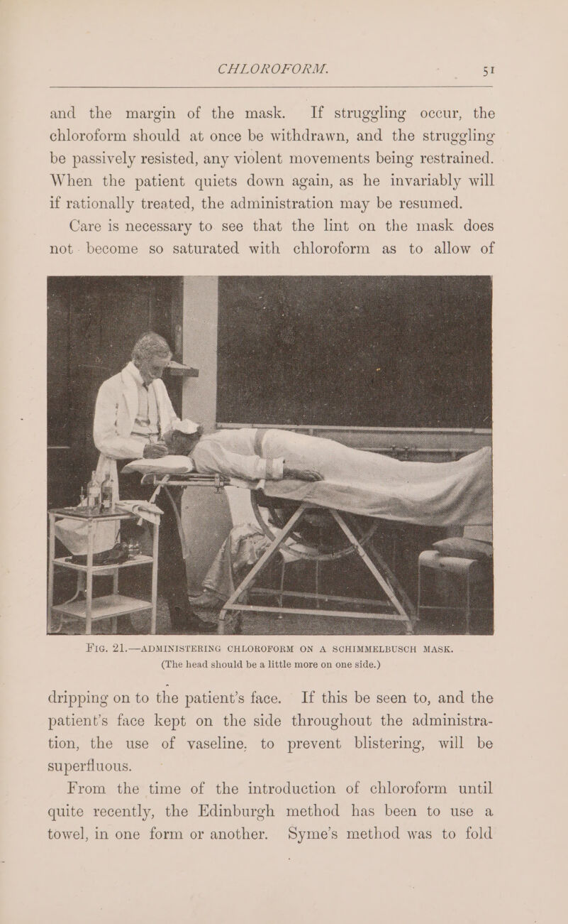 and the margin of the mask. If struggling occur, the chloroform should at once be withdrawn, and the struggling be passively resisted, any violent movements being restrained. When the patient quiets down again, as he invariably will if rationally treated, the administration may be resumed. Care is necessary to see that the lint on the mask does not. become so saturated with chloroform as to allow of dripping on to the patient’s face. If this be seen to, and the patient’s face kept on the side throughout the administra- tion, the use of vaseline, to prevent blistering, will be superfluous. From the time of the introduction of chloroform until quite recently, the Edinburgh method has been to use a towel, in one form or another. Syme’s method was to fold