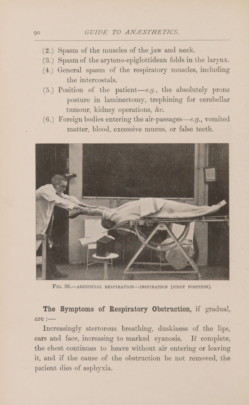 (2.) Spasm of the muscles of the jaw and neck. (3.) Spasm of the aryteno-epiglottidean folds in the larynx. (4.) General spasm of the respiratory muscles, including the intercostals. (5.) Position of the patient—e.g., the absolutely prone posture in laminectomy, trephining for cerebellar tumour, kidney operations, &c. (6.) Foreign bodies entering the air-passages—e.g., vomited matter, blood, excessive mucus, or false teeth. The Symptoms of Respiratory Obstruction, if gradual, are :— Increasingly stertorous breathing, duskiness of the lips, ears and face, increasing to marked cyanosis. If complete, the chest continues to heave without air entering or leaving it, and if the cause of the obstruction be not removed, the patient dies of asphyxia.