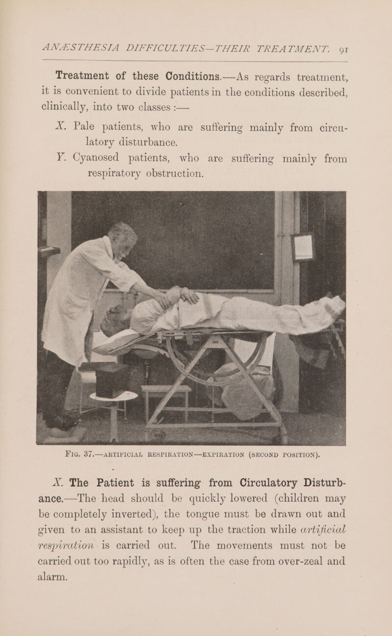 Treatment of these Conditions.—As regards treatment, it is convenient to divide patients in the conditions described, clinically, into two classes :-— X. Pale patients, who are suffering mainly from circu- latory disturbance. Y. Cyanosed patients, who are suffering mainly from respiratory obstruction. &gt; A. The Patient is suffering from Circulatory Disturb- ance.—The head should be quickly lowered (children may be completely inverted), the tongue must be drawn out and given to an assistant to keep up the traction while artificial resprration 1s carried out. The movements must not be carried out too rapidly, as is often the case from over-zeal and alarm.