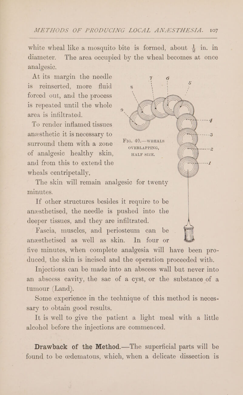white wheal like a mosquito bite is formed, about 4 in, in diameter. The area occupied by the wheal becomes at once analgesic. At its margin the needle 7G is reinserted, more fluid 8 \ 3 2 forced out, and the process \ : =~! is repeated until the whole iG q@G mY area is infiltrated. a Sy VE x To render inflamed tissues ey anzesthetic it is necessary to , Fic. 40.—wHEALS ‘ j OVERLAPPING, of analgesic healthy skin, HALF SIZE. surround them with a zone and from this to extend the wheals centripetally. The skin will remain analgesic for twenty minutes. If other structures besides it require to be anesthetised, the needle is pushed into the deeper tissues, and they are infiltrated. anesthetised as well as skin. In four or five minutes, when complete analgesia will have been pro- duced, the skin is incised and the operation proceeded with. Injections can be made into an abscess wall but never into an abscess cavity, the sac of a cyst, or the substance of a tumour (Land). Some experience in the technique of this method is neces- sary to obtain good results. It is well to give the patient a light meal with a little alcohol before the injections are commenced. Drawback of the Method.—The superficial parts will be found to be cedematous, which, when a delicate dissection is