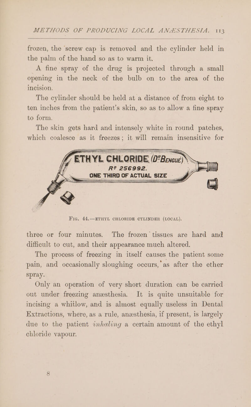 frozen, the ‘screw cap is removed and the cylinder held in the palm of the hand so as to warm it. A. fine spray of the drug is projected through a small opening in the neck of the bulb on to the area of the incision. The cylinder should be held at a distance of from eight to ten inches from the patient’s skin, so as to allow a fine spray to form. The skin gets hard and intensely white in round patches, which coalesce as it freezes; it will remain insensitive for / ETHYL C CHL LORID IDE (D*BencueS R? 256992. , ONE THIRD OF ACTUAL SIZE three or four minutes. The frozen tissues are hard and difficult to cut, and their appearance much altered. The process of freezing in itself causes the patient some pain, and occasionally sloughing occurs,’as after the ether spray. Only an operation of very short duration can be carried out under freezing anesthesia. It is quite unsuitable for incising a whitlow, and is almost equally useless in Dental Extractions, where, as a rule, anesthesia, if present, 1s largely due to the patient whaling a certain amount of the ethyl chloride vapour.