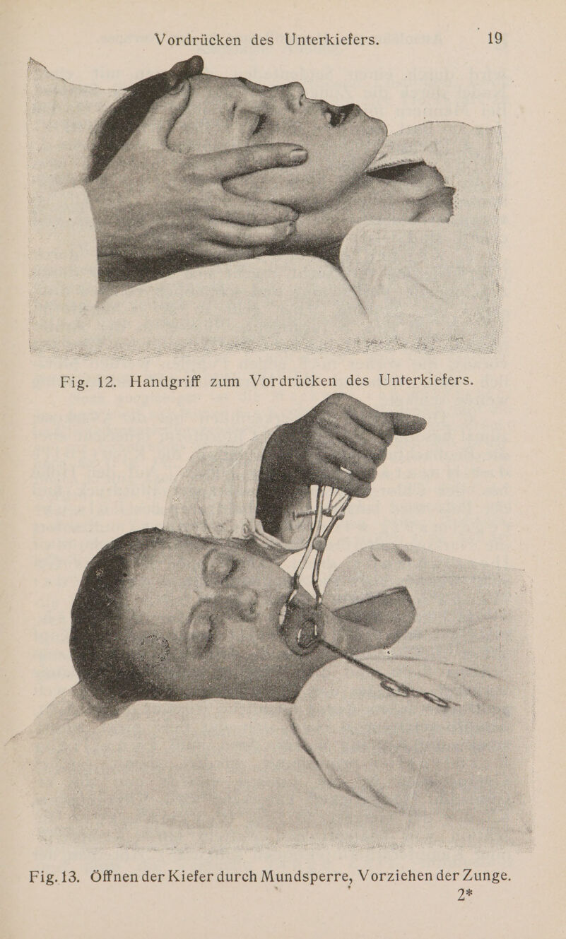 13. Öffnen der Kiefer durch Mundsperre, Vorziehen der Zunge. ö ; 2