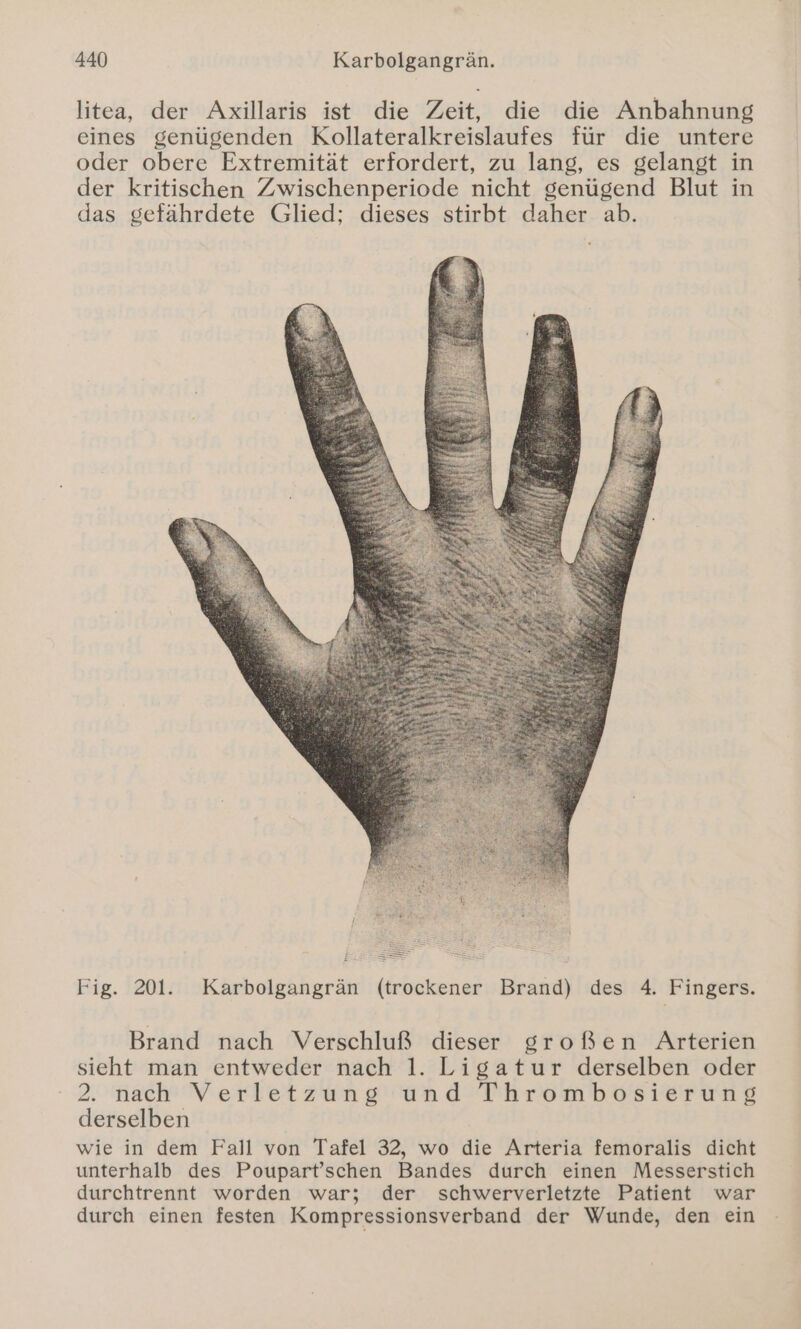 litea, der Axillaris ist die Zeit, die die Anbahnung eines genügenden Kollateralkreislaufes für die untere oder obere Extremität erfordert, zu lang, es gelangt in der kritischen Zwischenperiode nicht genügend Blut in das gefährdete Glied; dieses stirbt daher ab. Fig. 201. Karbolgangrän (trockener Brand) des 4. Fingers. Brand nach Verschluß dieser großen Arterien sieht man entweder nach 1. Ligatur derselben oder 2. nach’ Verletzung und Thrombosierung derselben wie in dem Fall von Tafel 32, wo die Arteria femoralis dicht unterhalb des Poupart’schen Bandes durch einen Messerstich durchtrennt worden war; der schwerverletzte Patient war durch einen festen Kompressionsverband der Wunde, den ein