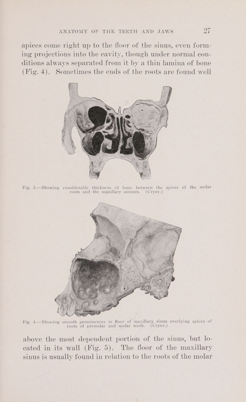 hod apices come right up to the floor of the sinus, even form- ing projections into the cavity, though under normal con- ditions always separated from it by a thin lamina of bone (Hig. 4). Sometimes the ends of the roots are found well Fig. 3—Showing considerable thickness of bone between the apices of the molar roots and the maxillary sinuses. (Cryer.) Fig. 4.—Showing smooth prominences in floor of maxillary sinus overlying apices of roots of premolar and molar teeth. (Cryer.) above the most dependent portion of the sinus, but lo- cated in its wall (Fig. 5). The floor of the maxillary sinus is usually found in relation to the roots of the molar