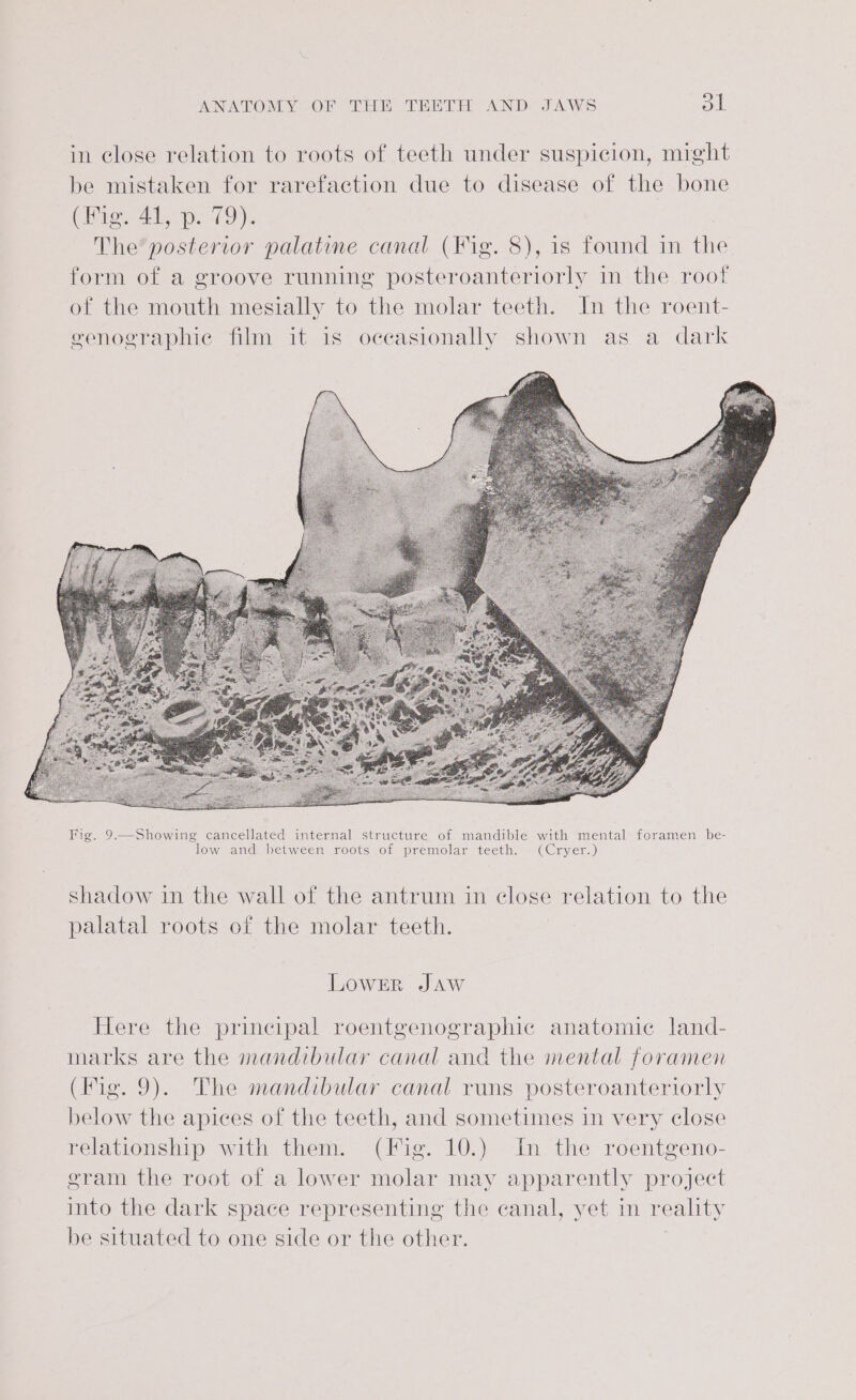 in close relation to roots of teeth under suspicion, mrght be mistaken for rarefaction due to disease of the bone (io AL 2-79). The’ posterior palatine canal (Fig. 8), is found in the form of a groove running posteroanteriorly in the roof of the mouth mesially to the molar teeth. In the roent- genographic film it is occasionally shown as a dark Fig. 9.—Showing cancellated internal structure of mandible with mental foramen be- low and hetween roots of premolar teeth. | (Cryer.) shadow in the wall of the antrum in close relation to the palatal roots of the molar teeth. LowER JAW Here the principal roentgenographic anatomic land- marks are the mandibular canal and the mental foramen (Iie. 9). The mandibular canal runs posteroanteriorly below the apices of the teeth, and sometimes in very close relationship with them. (Fig. 10.) In the roentgeno- gram the root of a lower molar may apparently project into the dark space representing the canal, yet in reality be situated to one side or the other.