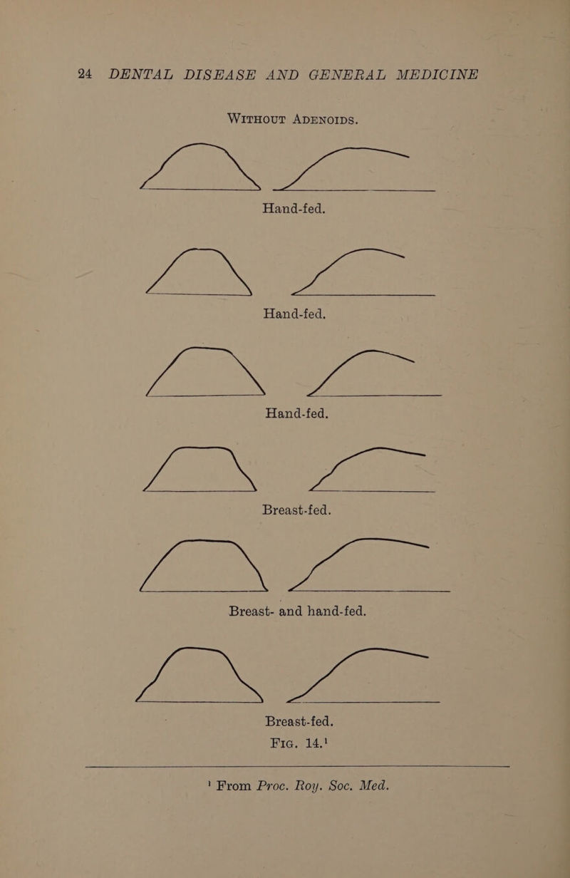 WITHOUT ADENOIDS. oe Hand-fed. Hand-fed. Hand-fed. Li a Breast-fed. (Se Breast- and hand-fed. La Breast-fed. Fia. 14.!