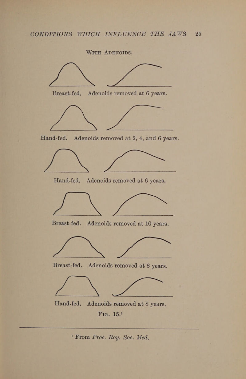 WitH ADENOIDS. ae Breast-fed. Adenoids removed at 6 years. aa Hand-fed. Adenoids removed at 2, 4, and 6 years. ai Hand-fed. Adenoids removed at 6 years. aa Breast-fed. Adenoids removed at 10 years. [a Breast-fed. Adenoids removed at 8 years. oe Hand-fed. Adenoids removed at 8 years. Fiq. 15.
