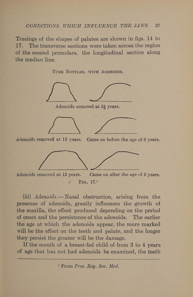 Tracings of the shapes of palates are shown in figs. 14 to 17. The transverse sections were taken across the region of the second premolars, the longitudinal section along the median line. TuBbE BoTTLEs, WITH ADENOIDS. a ae Adenoids removed at 53 years. SS ae Adenoids removed at 13 years. Came on before the age of 6 years. 1a Adenoids removed at 15 years. Came on after the age of 6 years. Hic, 17. (iii) Adenoids.— Nasal obstruction, arising from the presence of adenoids, greatly influences the growth of the maxilla, the effect produced depending on the period of onset and the persistence of the adenoids. The earlier the age at which the adenoids appear, the more marked will be the effect on the teeth and palate, and the longer they persist the greater will be the damage. If the mouth of a breast-fed child of from 3 to 4 years of age that has not had adenoids be examined, the teeth