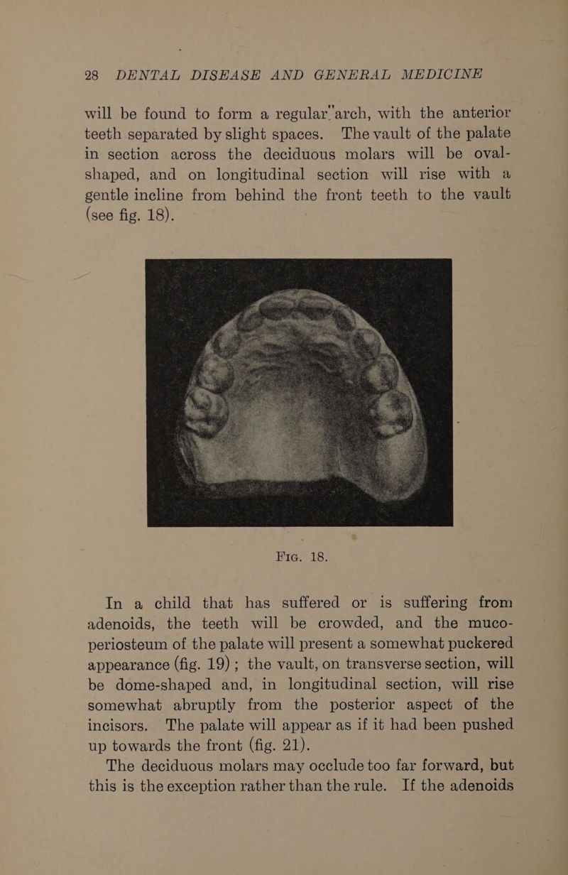 will be found to form a regular‘arch, with the anterior teeth separated by slight spaces. The vault of the palate in section across the deciduous molars will be oval- shaped, and on longitudinal section will rise with a gentle incline from behind the front teeth to the vault (see fig. 18). In a child that has suffered or is suffering from adenoids, the teeth will be crowded, and the muco- periosteum of the palate will present a somewhat puckered appearance (fig. 19); the vault, on transverse section, will be dome-shaped and, in longitudinal section, will rise somewhat abruptly from the posterior aspect of the incisors. The palate will appear as if it had been pushed up towards the front (fig. 21). The deciduous molars may occlude too far forward, but this is the exception rather than the rule. If the adenoids