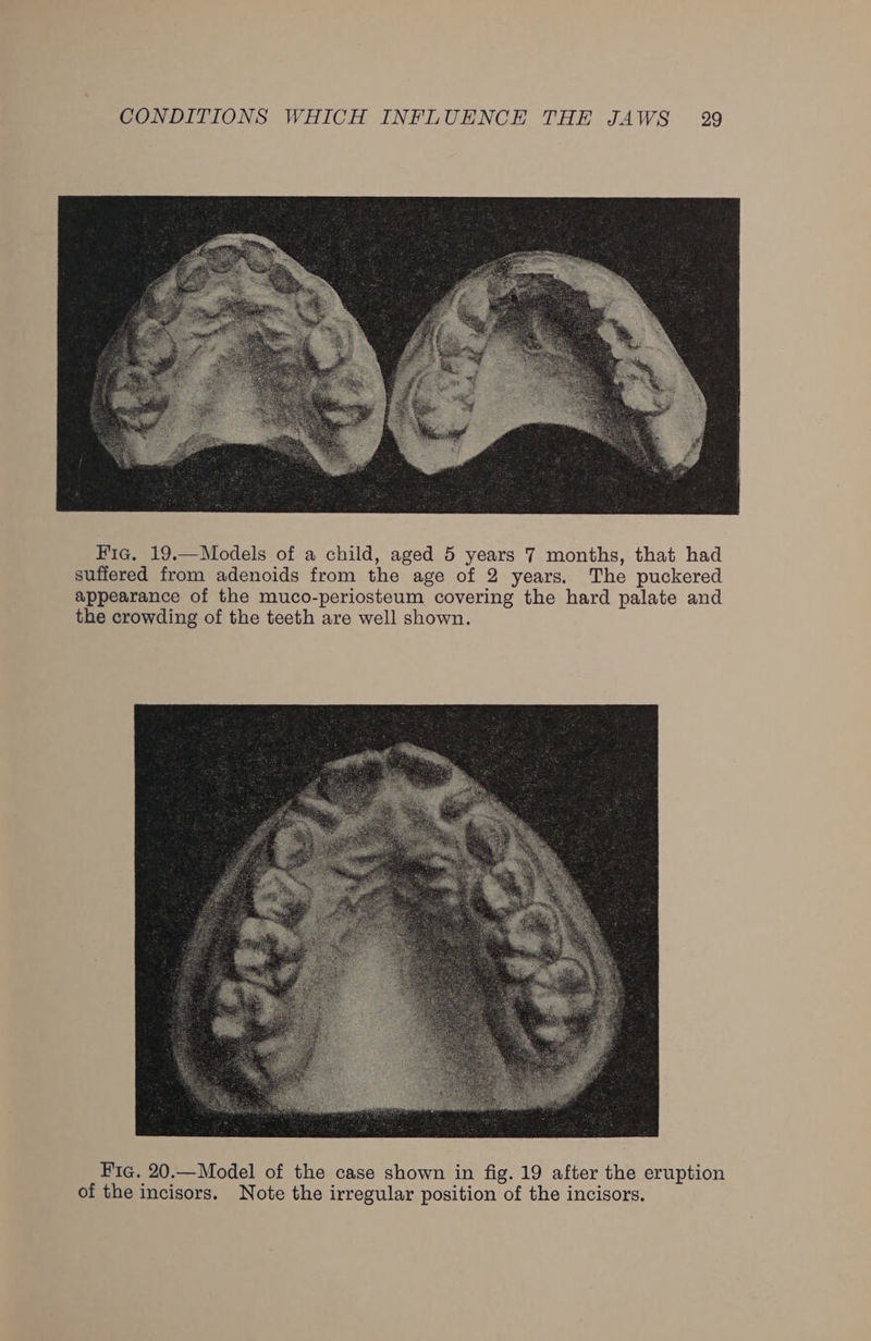 Fia. 19.—Models of a child, aged 5 years 7 months, that had suffered from adenoids from the age of 2 years. The puckered appearance of the muco-periosteum covering the hard palate and the crowding of the teeth are well shown. Fig. 20.—Model of the case shown in fig. 19 after the eruption of the incisors. Note the irregular position of the incisors.