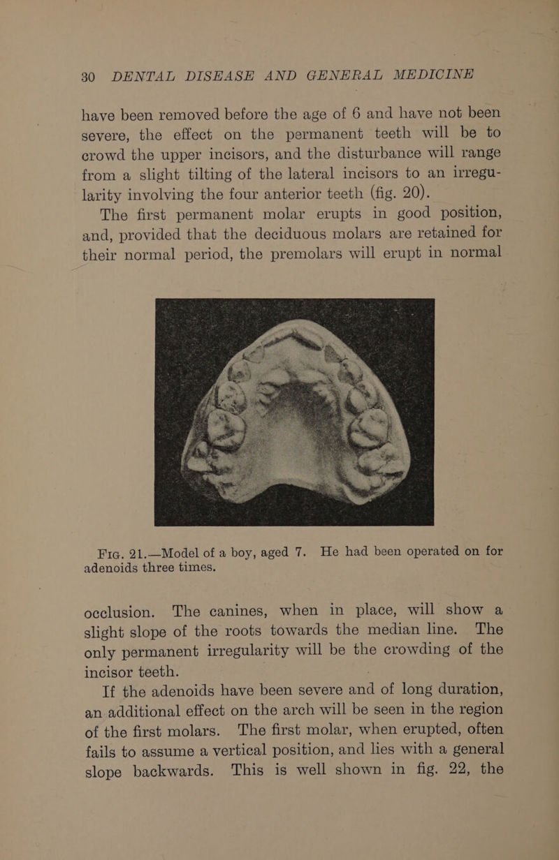 have been removed before the age of 6 and have not been severe, the effect on the permanent teeth will be to crowd the upper incisors, and the disturbance will range from a slight tilting of the lateral incisors to an irregu- larity involving the four anterior teeth (fig. 20). The first permanent molar erupts in good position, and, provided that the deciduous molars are retained for their normal period, the premolars will erupt in normal Fig. 21.—Model of a boy, aged 7. He had been operated on for adenoids three times. occlusion. The canines, when in place, will show a slight slope of the roots towards the median line. The only permanent irregularity will be the crowding of the incisor teeth. , Tf the adenoids have been severe and of long duration, an additional effect on the arch will be seen in the region of the first molars. The first molar, when erupted, often fails to assume a vertical position, and les with a general slope backwards. This is well shown in fig. 22, the