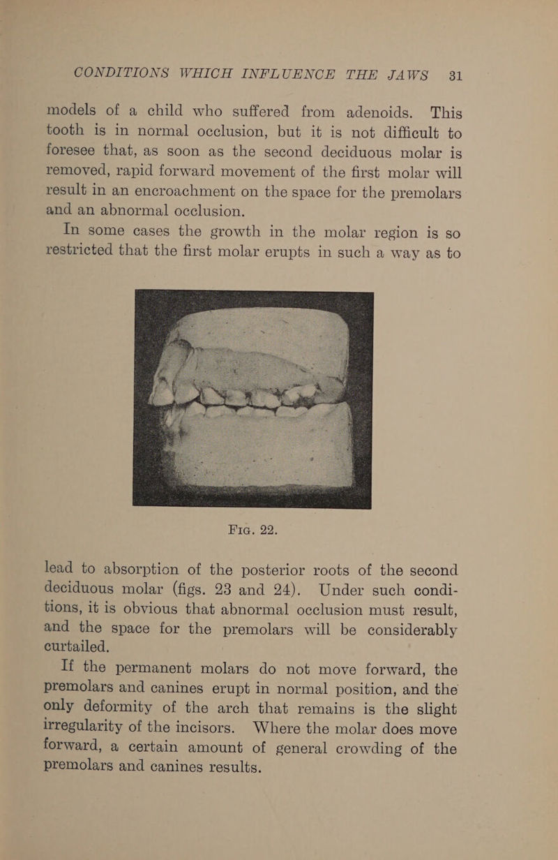 models of a child who suffered from adenoids. This tooth is in normal occlusion, but it is not difficult to foresee that, as soon as the second deciduous molar is removed, rapid forward movement of the first molar will result in an encroachment on the space for the premolars and an abnormal occlusion. In some cases the growth in the molar region is so restricted that the first molar erupts in such a way as to lead to absorption of the posterior roots of the second deciduous molar (figs. 23 and 24). Under such condi- tions, it is obvious that abnormal occlusion must result, and the space for the premolars will be considerably curtailed. If the permanent molars do not move forward, the premolars and canines erupt in normal position, and the only deformity of the arch that remains is the slight irregularity of the incisors. Where the molar does move forward, a certain amount of general crowding of the premolars and canines results.