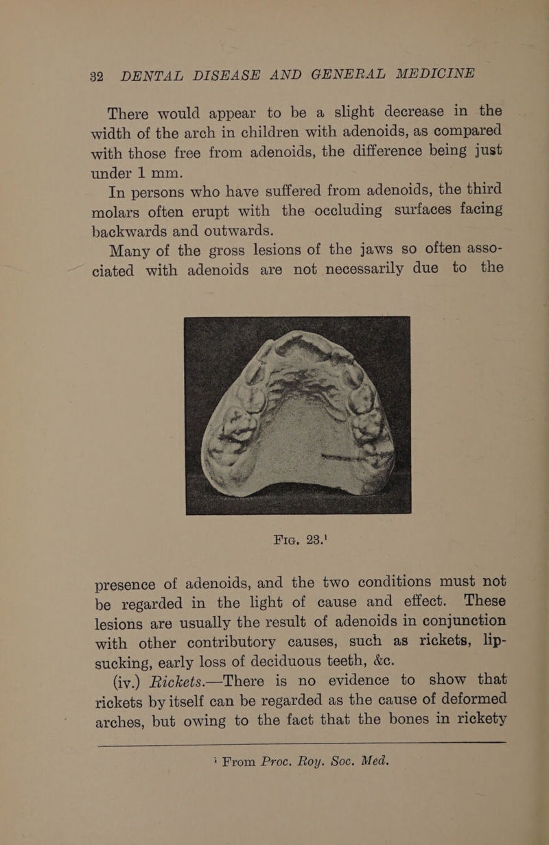 There would appear to be a slight decrease in the width of the arch in children with adenoids, as compared with those free from adenoids, the difference being just under 1 mm. In persons who have suffered from adenoids, the third molars often erupt with the occluding surfaces facing backwards and outwards. Many of the gross lesions of the jaws so often asso- ciated with adenoids are not necessarily due to the presence of adenoids, and the two conditions must not be regarded in the light of cause and effect. These lesions are usually the result of adenoids in conjunction with other contributory causes, such as rickets, lip- sucking, early loss of deciduous teeth, &amp;c. (iv.) Rickets—There is no evidence to show that rickets by itself can be regarded as the cause of deformed arches, but owing to the fact that the bones in rickety