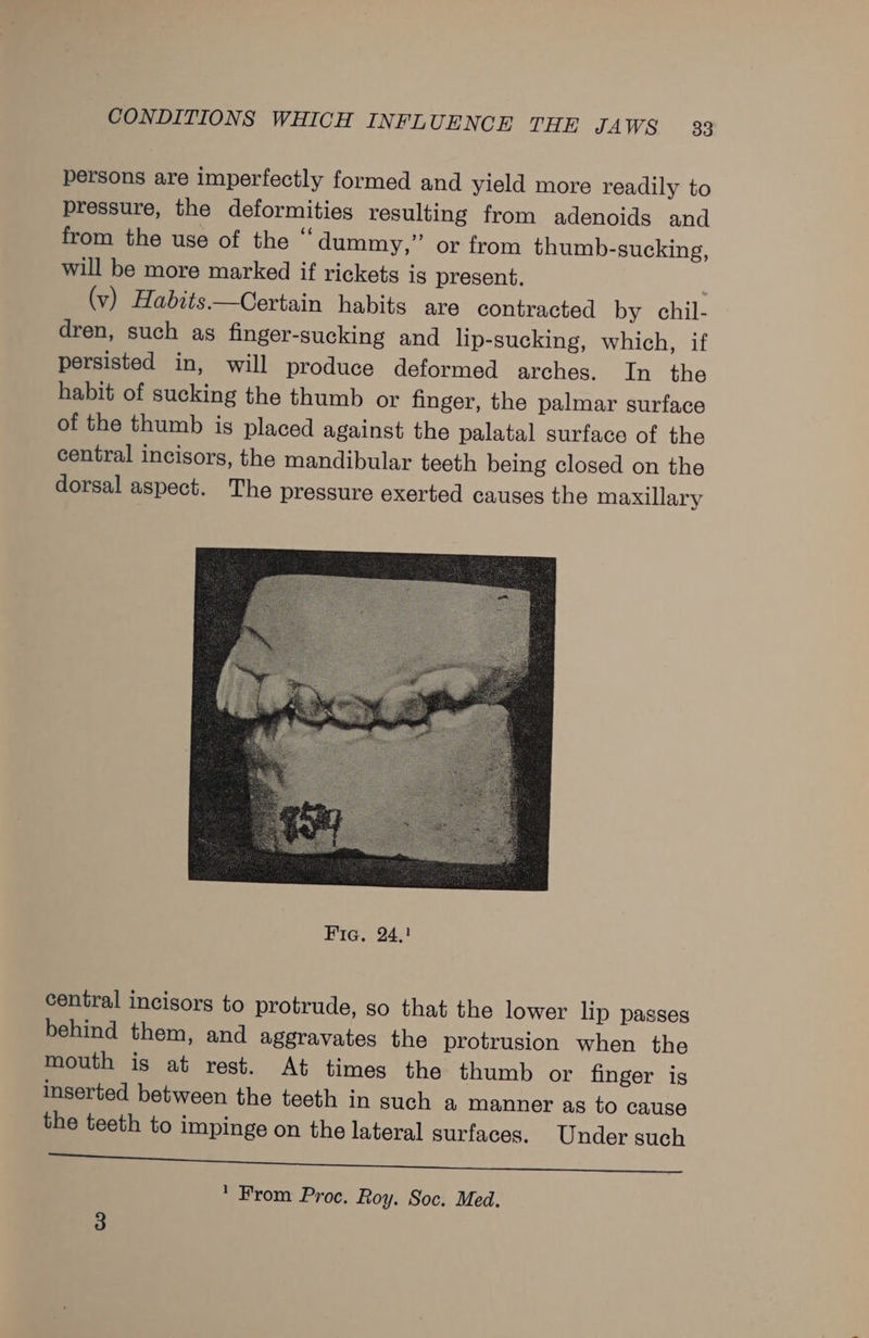 persons are imperfectly formed and yield more readily to pressure, the deformities resulting from adenoids and from the use of the “dummy,” or from thumb-sucking, will be more marked if rickets ig present. (v) Habdits.—Certain habits are contracted by chil- dren, such as finger-sucking and lip-sucking, which, if persisted in, will produce deformed arches. In the habit of sucking the thumb or finger, the palmar surface of the thumb is placed against the palatal surface of the central incisors, the mandibular teeth being closed on the dorsal aspect. The pressure exerted causes the maxillary central incisors to protrude, so that the lower lip passes behind them, and aggravates the protrusion when the mouth is at rest. At times the thumb or finger is inserted between the teeth in such a manner as to cause the teeth to impinge on the lateral surfaces. Under such ee  From Proc. Roy. Soc. Med. 3