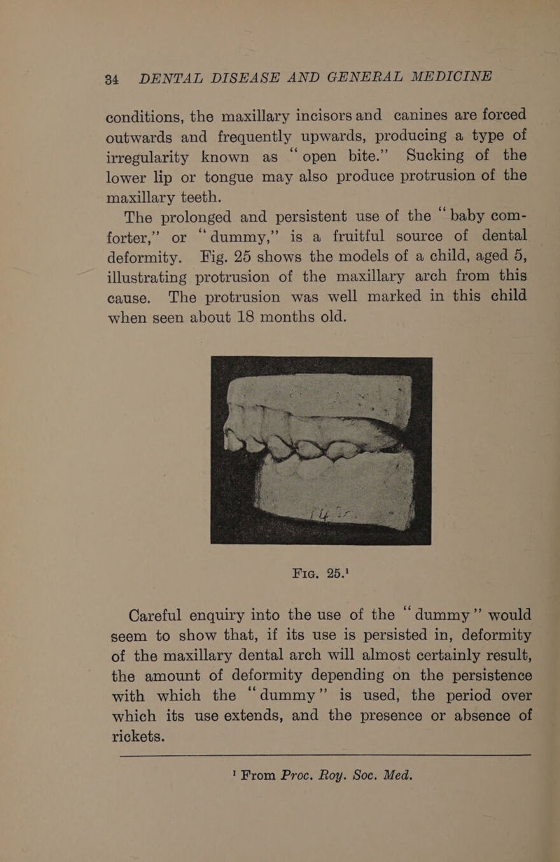 conditions, the maxillary incisorsand canines are forced outwards and frequently upwards, producing a type of irregularity known as “open bite.” Sucking of the lower lip or tongue may also produce protrusion of the maxillary teeth. The prolonged and persistent use of the “baby com- forter,’ or “dummy,” is a fruitful source of dental deformity. Fig. 25 shows the models of a child, aged 5, illustrating protrusion of the maxillary arch from this cause. The protrusion was well marked in this child when seen about 18 months old. Careful enquiry into the use of the “dummy” would seem to show that, if its use is persisted in, deformity of the maxillary dental arch will almost certainly result, the amount of deformity depending on the persistence with which the “dummy” is used, the period over which its use extends, and the presence or absence of rickets.