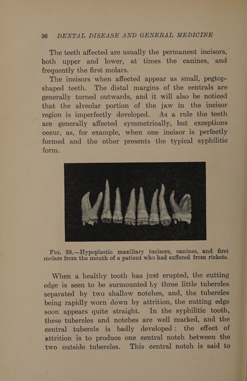 The teeth affected are usually the permanent incisors, both upper and lower, at times the canines, and frequently the first molars. The incisors when affected appear as small, pegtop- shaped teeth. The distal margins of the centrals are generally turned outwards, and it will also be noticed that the alveolar portion of the jaw in the incisor region is imperfectly developed. As a rule the teeth are generally affected symmetrically, but exceptions occur, as, for example, when one incisor is perfectly formed and the other presents the typical syphilitic form. Fic. 28.—Hypoplastic maxillary incisors, canines, and first molars from the mouth of a patient who had suffered from rickets. When a healthy tooth has just erupted, the cutting edge is seen to be surmounted by three little tubercles separated by two shallow notches, and, the tubercles being rapidly worn down by attrition, the cutting edge soon appears quite straight. In the syphilitic tooth, these tubercles and notches are well marked, and the central tubercle is badly developed: the effect of attrition is to produce one central notch between the two outside tubercles. This central notch is said to