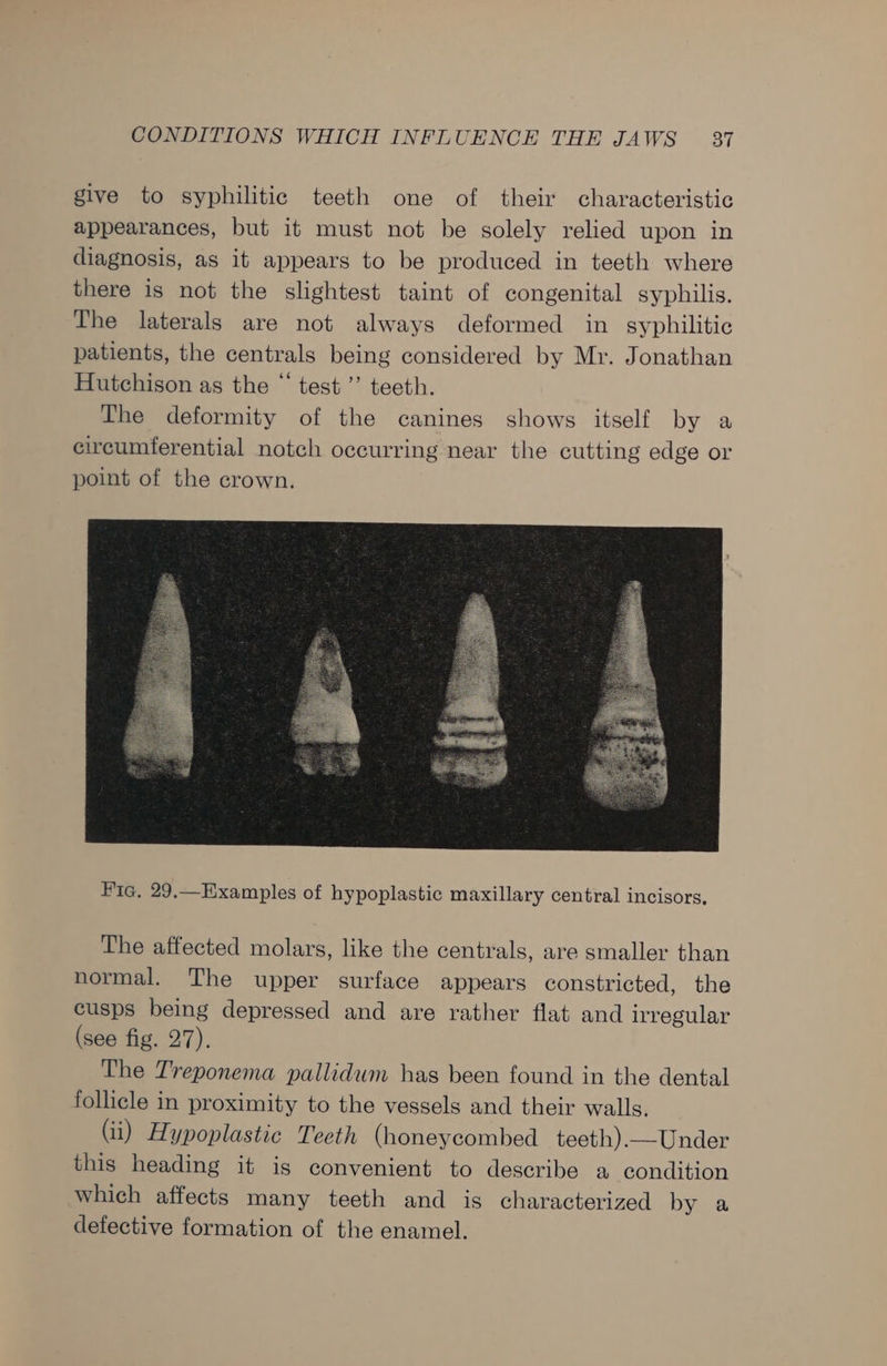give to syphilitic teeth one of their characteristic appearances, but it must not be solely relied upon in diagnosis, as it appears to be produced in teeth where there is not the slightest taint of congenital syphilis. The laterals are not always deformed in syphilitic patients, the centrals being considered by Mr. Jonathan Hutchison as the “ test ’”’ teeth. The deformity of the canines shows itself by a circumferential notch occurring near the cutting edge or point of the crown. The affected molars, like the centrals, are smaller than normal. The upper surface appears constricted, the cusps being depressed and are rather flat and irregular (see fig. 27). The Treponema pallidum has been found in the dental follicle in proximity to the vessels and their walls. (ii) Hypoplastic Teeth (honeycombed teeth). —Under this heading it is convenient to describe a condition which affects many teeth and is characterized by a defective formation of the enamel.