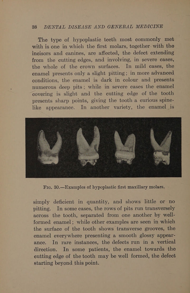 The type of hypoplastic teeth most commonly met with is one in which the first molars, together. with the incisors and canines, are affected, the defect extending from the cutting edges, and involving, in severe cases, the whole of the crown surfaces. In mild eases, the enamel presents only a slight pitting; in more advanced conditions, the enamel is dark in colour and presents numerous deep pits; while in severe cases the enamel covering is slight and the cutting edge of the tooth presents sharp points, giving the tooth a curious spine- like appearance. In another variety, the enamel is simply deficient in quantity, and shows little or no pitting. In some cases, the rows of pits run transversely across the tooth, separated from one another by well- formed enamel; while other examples are seen in which the surface of the tooth shows transverse grooves, the enamel everywhere presenting a smooth glossy appear- ance. In rare instances, the defects run in a vertical direction. In some patients, the enamel towards the cutting edge of the tooth may be well formed, the defect starting beyond this point.