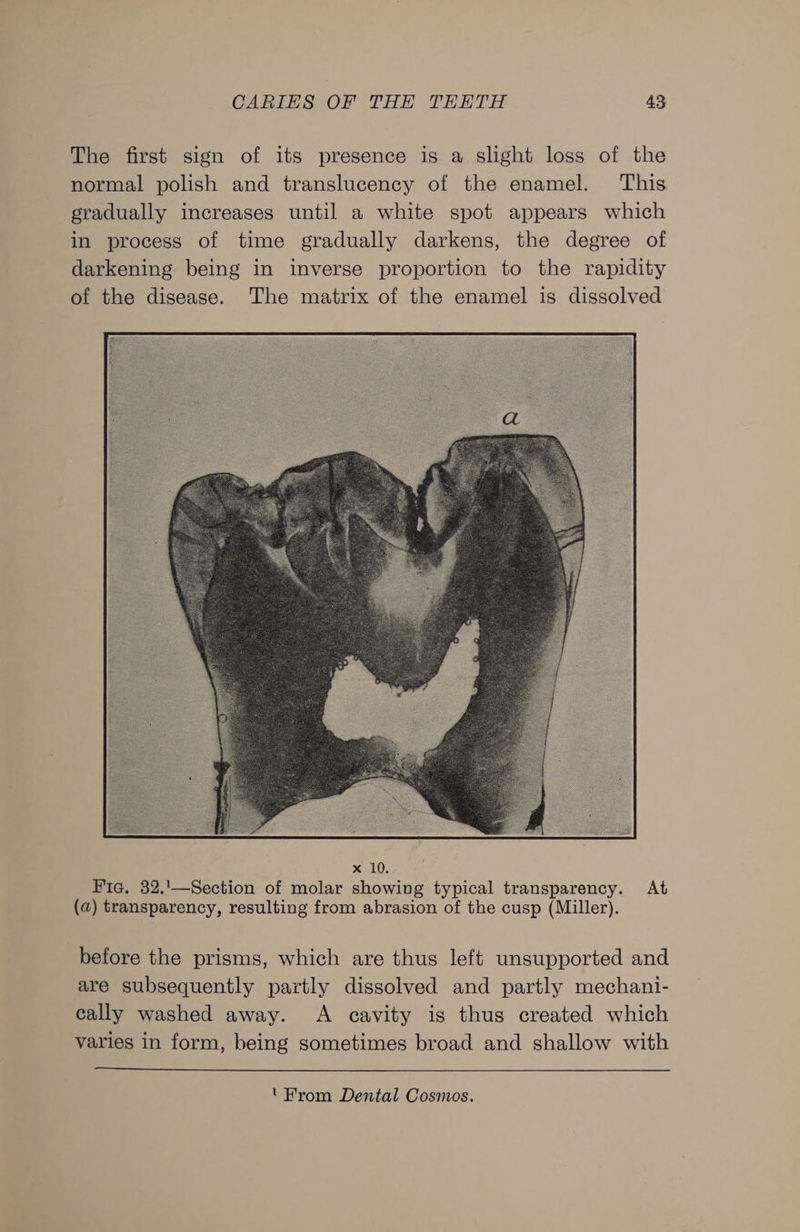 The first sign of its presence is a slight loss of the normal polish and translucency of the enamel. This gradually increases until a white spot appears which in process of time gradually darkens, the degree of darkening being in inverse proportion to the rapidity of the disease. The matrix of the enamel is dissolved Fic. 32.'\—Section of molar showing typical transparency. At (a) transparency, resulting from abrasion of the cusp (Miller). before the prisms, which are thus left unsupported and are subsequently partly dissolved and partly mechani- cally washed away. A cavity is thus created which varies in form, being sometimes broad and shallow with 'From Dental Cosmos.