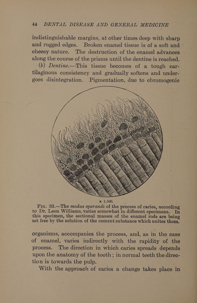 indistinguishable margins, at other times deep with sharp and rugged edges. Broken enamel tissue is of a soft and cheesy nature. The destruction of the enamel advances along the course of the prisms until the dentine is reached. (b) Dentine—This tissue becomes of a tough car- tilaginous consistency and gradually softens and under- goes disintegration. Pigmentation, due to chromogenic SN Nt RS N  —~. \ AE sx). i Vk s Fie. 33.—The modus operandi of the process of caries, according to Dr. Leon Williams, varies somewhat in different specimens. In this specimen, the sectional masses of the enamel rods are being set free by the solution of the cement substance which unites them, organisms, accompanies the process, and, as in the case of enamel, varies indirectly with the rapidity of the process. The direction in which caries spreads depends upon the anatomy of the tooth ; in normal teeth the direc- tion is towards the pulp. With the approach of caries a change takes place in