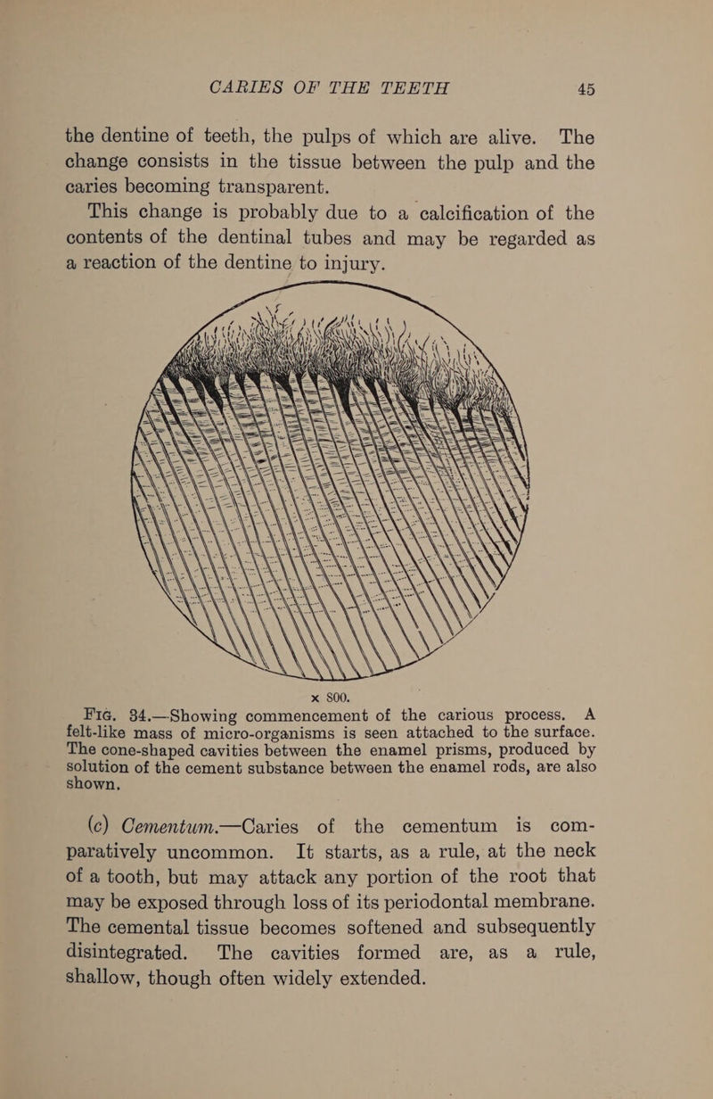 the dentine of teeth, the pulps of which are alive. The change consists in the tissue between the pulp and the caries becoming transparent. This change is probably due to a calcification of the contents of the dentinal tubes and may be regarded as a reaction of the dentine to injury. Fig, 84.—Showing commencement of the carious process. A felt-like mass of micro-organisms is seen attached to the surface. The cone-shaped cavities between the enamel prisms, produced by ela of the cement substance between the enamel rods, are also shown, (c) Cementum.—Caries of the cementum is com- paratively uncommon. It starts, as a rule, at the neck of a tooth, but may attack any portion of the root that may be exposed through loss of its periodontal membrane. The cemental tissue becomes softened and subsequently disintegrated. The cavities formed are, as a rule, shallow, though often widely extended.