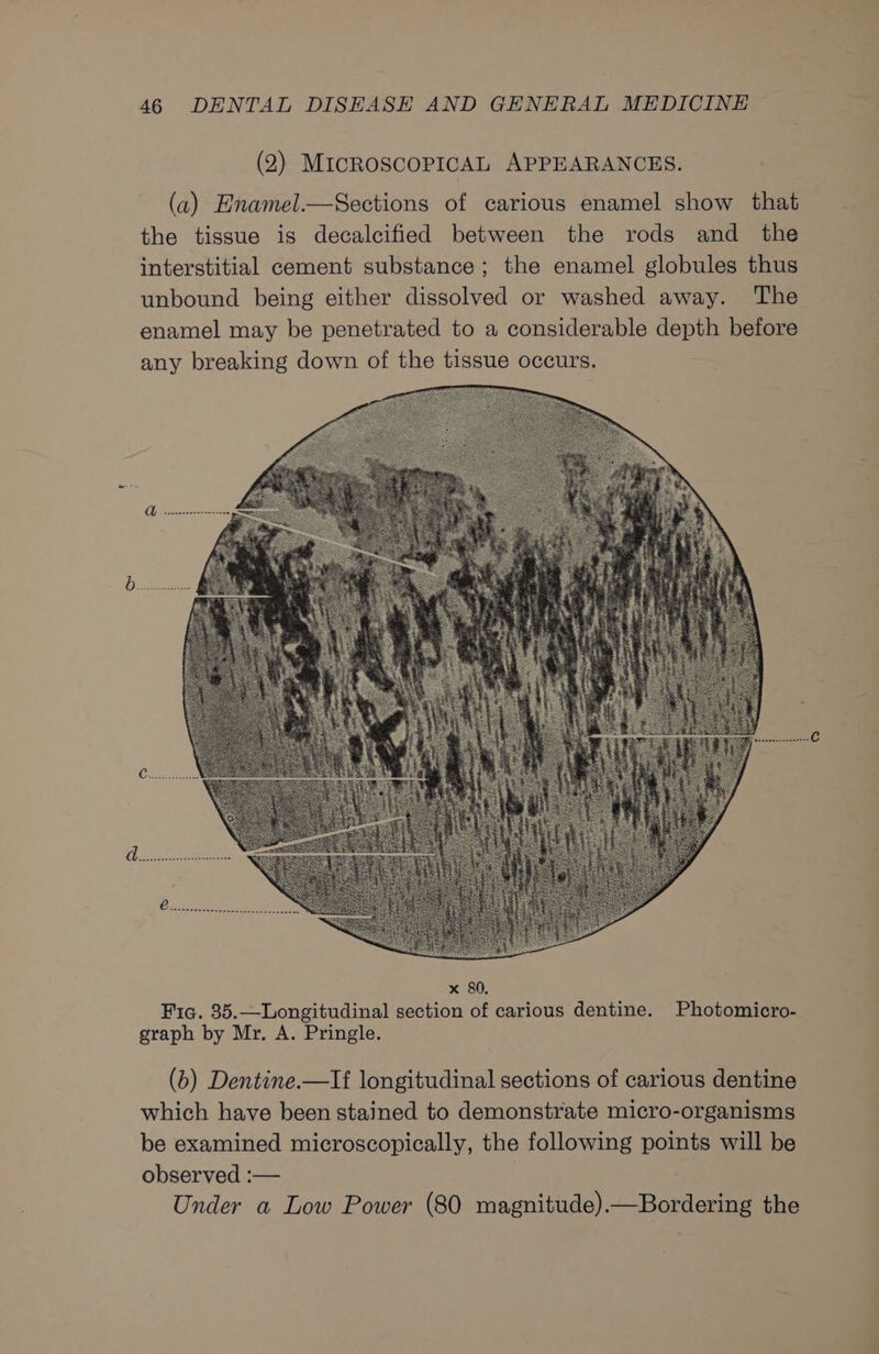(2) MicRoscoPIcAL APPEARANCES. x 80. Fic. 35.—Longitudinal section of carious dentine. Photomicro- graph by Mr. A. Pringle. (b) Dentine.—If longitudinal sections of carious dentine which have been stained to demonstrate micro-organisms be examined microscopically, the following points will be observed :— Under a Low Power (80 magnitude).—Bordering the