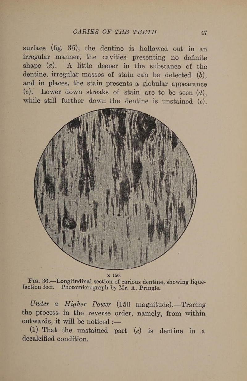 surface (fig. 35), the dentine is hollowed out in an irregular manner, the cavities presenting no definite | shape (a). A little deeper in the substance of the dentine, irregular masses of stain can be detected (b), and in places, the stain presents a globular appearance (c). Lower down streaks of stain are to be seen (d), while still further down the dentine is unstained (e). Under a Higher Power (150 magnitude).—Tracing the process in the reverse order, namely, from within outwards, it will be noticed :— (1) That the unstained part (e) is dentine in a decalcified condition.