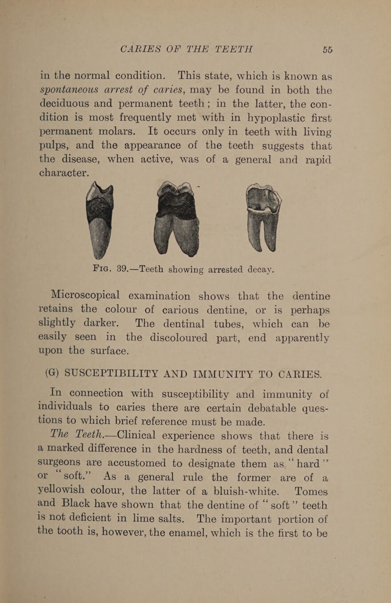 in the normal condition. ‘This state, which is known as spontaneous arrest of caries, may be found in both the deciduous and permanent teeth; in the latter, the con- dition is most frequently met with in hypoplastic first permanent molars. It occurs only in teeth with living pulps, and the appearance of the teeth suggests that the disease, when active, was of a general and rapid character. Fic. 39.—Teeth showing arrested decay. Microscopical examination shows that the dentine retains the colour of carious dentine, or is perhaps slightly darker. The dentinal tubes, which can be easily seen in the discoloured part, end apparently upon the surface. (G) SUSCEPTIBILITY AND IMMUNITY TO CARIES. In connection with susceptibility and immunity of individuals to caries there are certain debatable ques- tions to which brief reference must be made. The Teeth.—Clinical experience shows that there is a marked difference in the hardness of teeth, and dental surgeons are accustomed to designate them as hard”’ or soft.” As a general rule the former are of a yellowish colour, the latter of a bluish-white. Tomes and Black have shown that the dentine of ‘‘ soft” teeth is not deficient in lime salts. The important portion of the tooth is, however, the enamel, which is the first to be